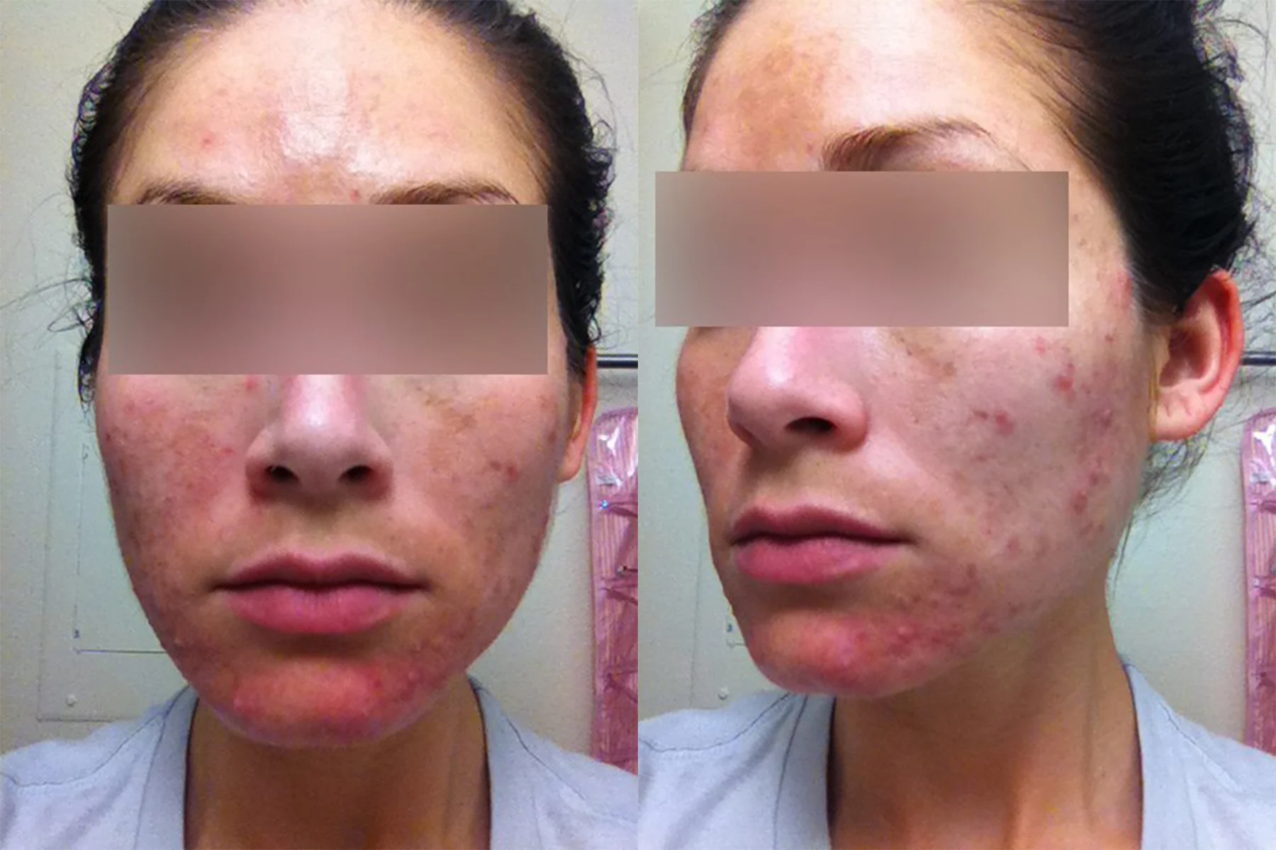 Acne Before.jpg