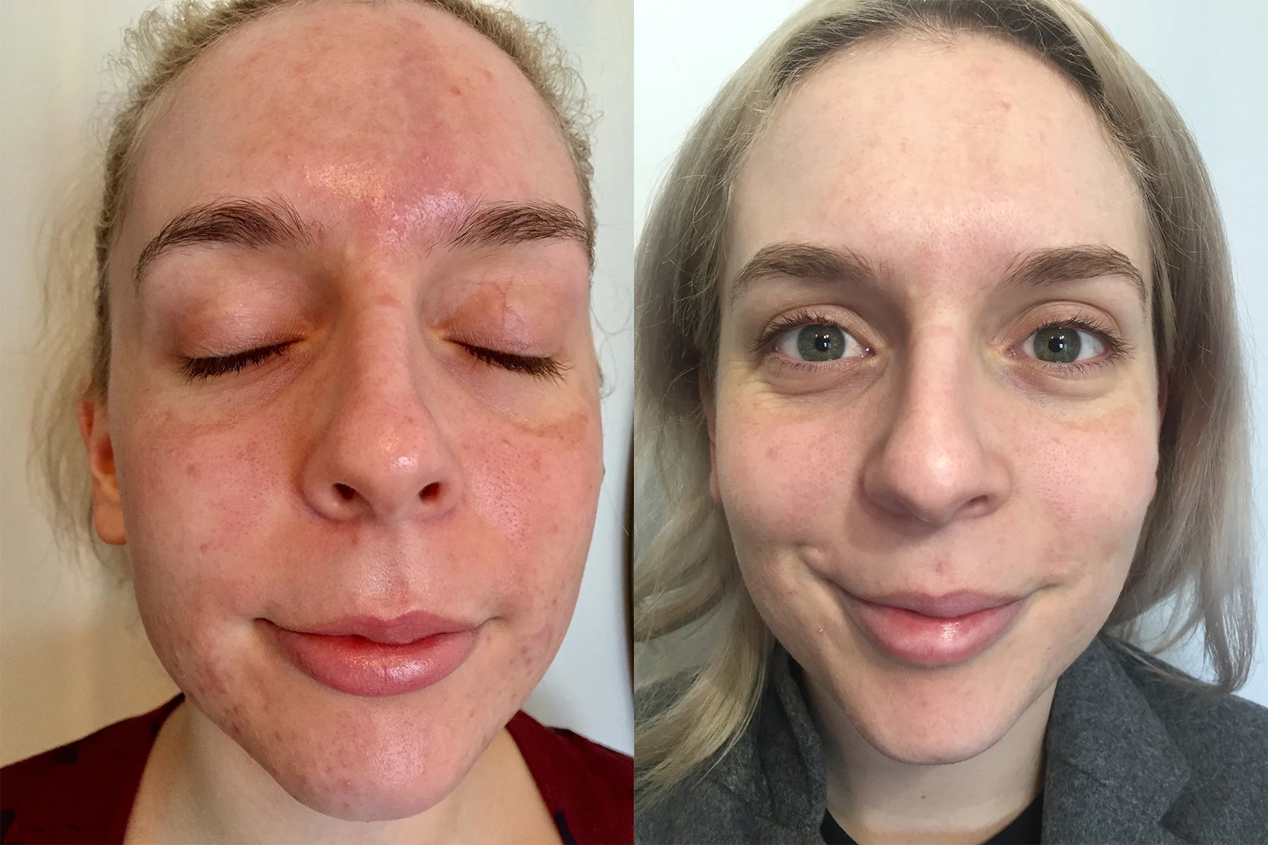 Results obtained from a series of 3 Silk Peel Dermal Infusions and 3 Level 2 Peels