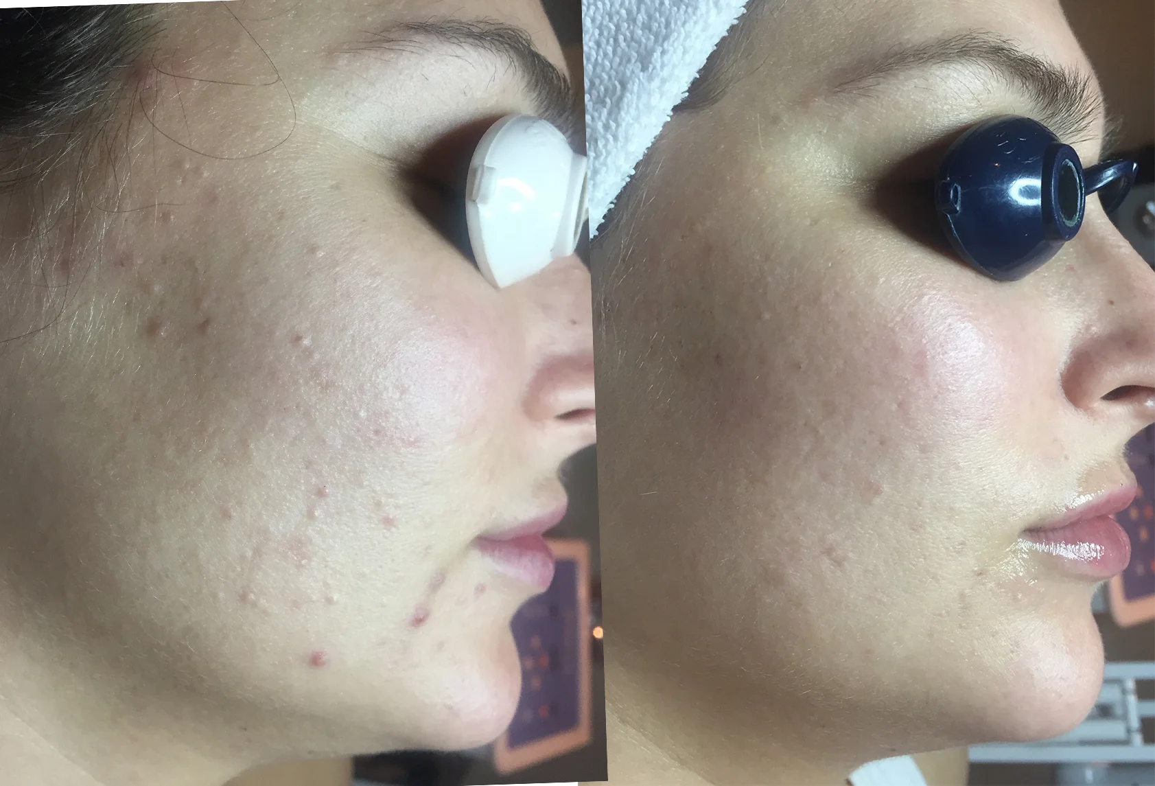 Results obtained with 2 Level 2 Peels