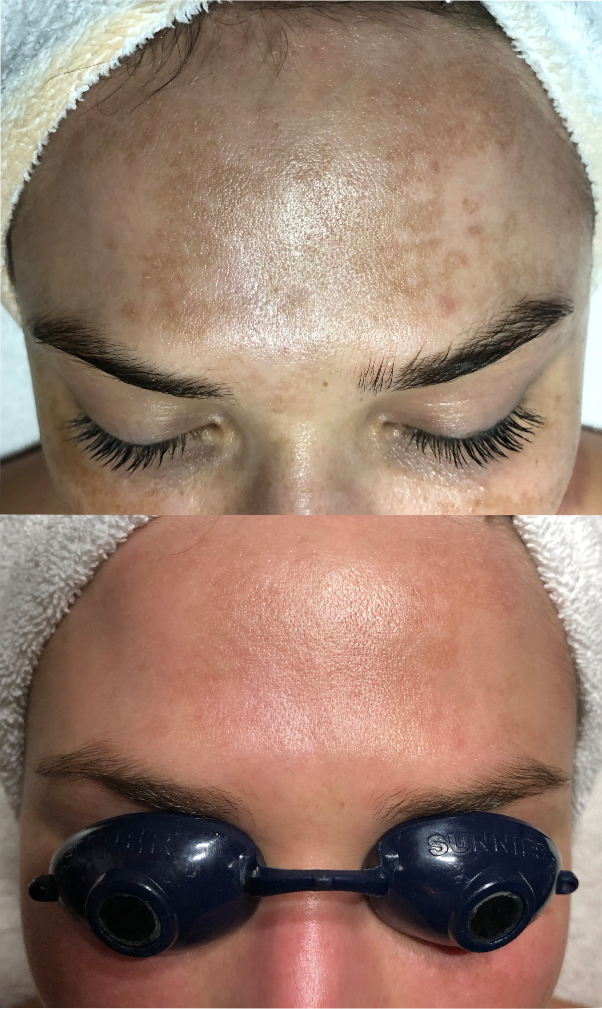 Pigmentation Forehead After.jpg