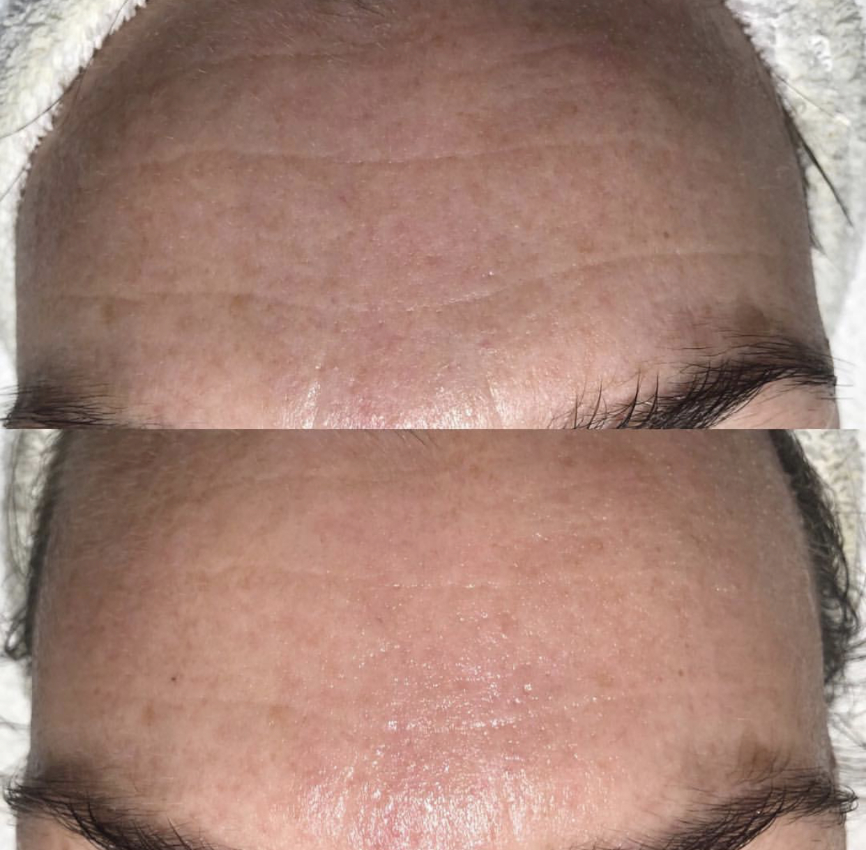 SilkPeel B&A.jpg