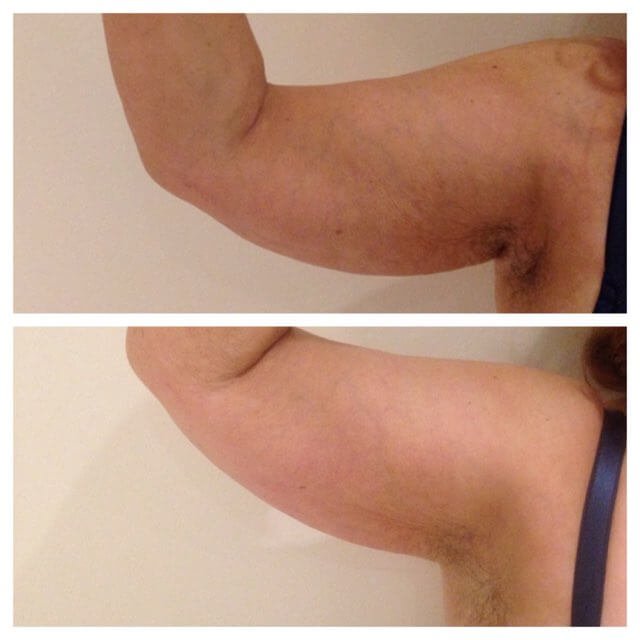 Arm-Before-After.jpg