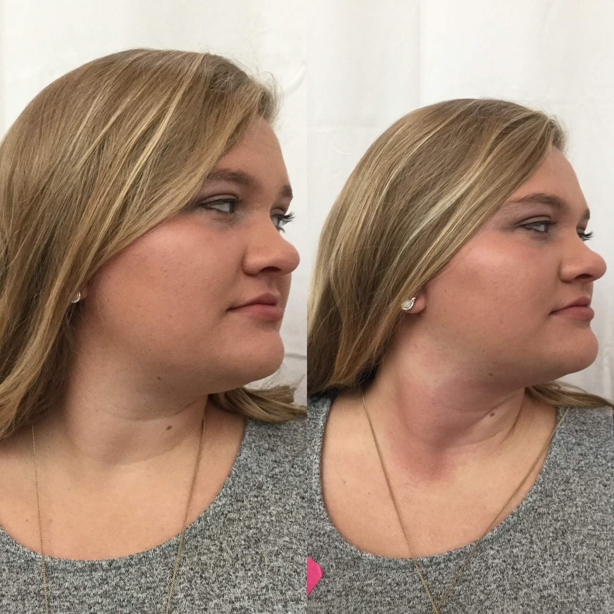 Double-Chin-Before-After-1.jpg