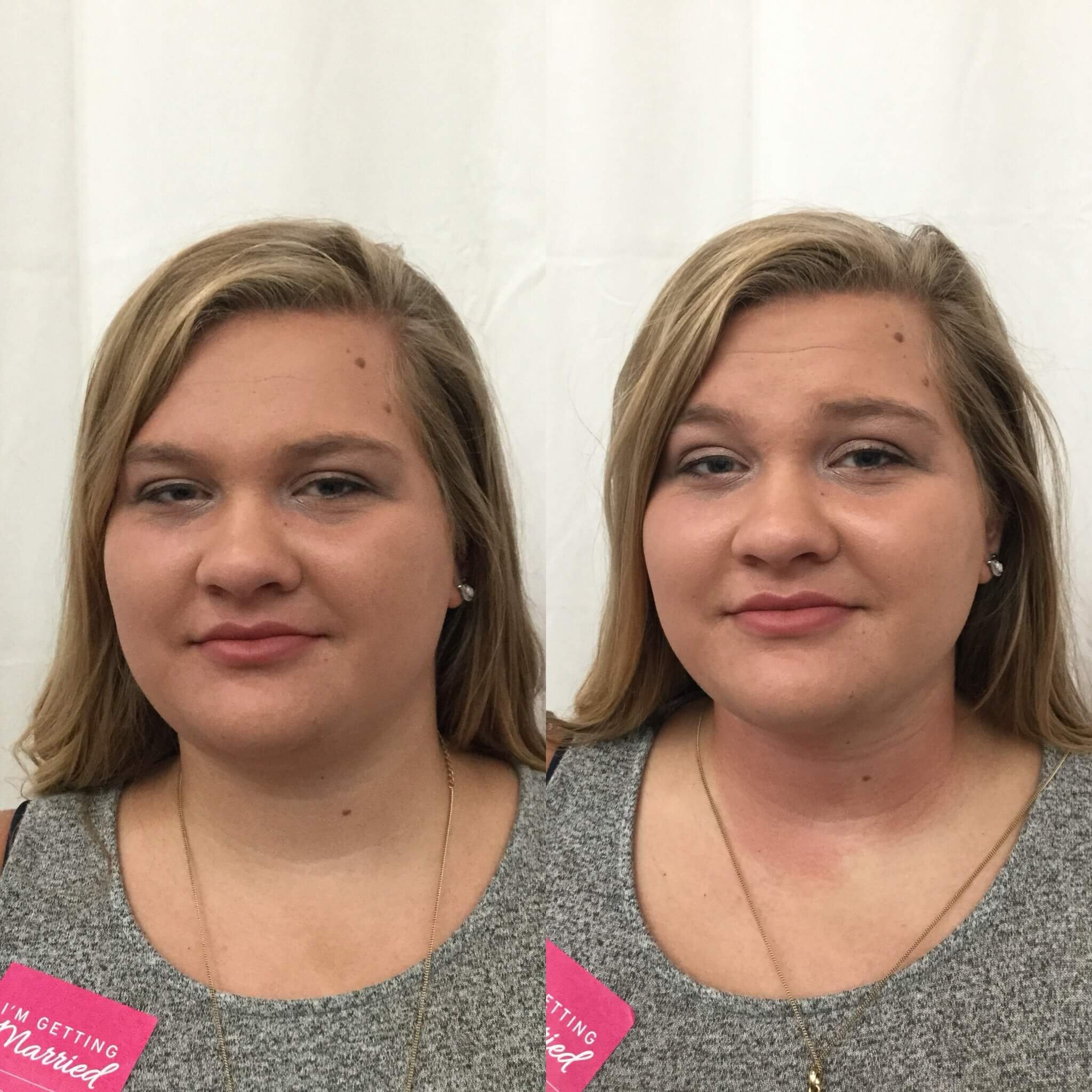 Double-Chin-Before-After-3.jpg
