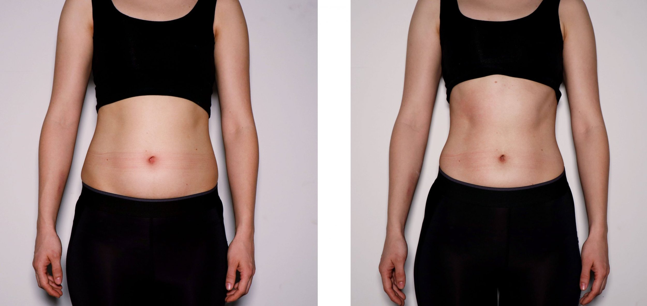 Female-Abdomen-Toning-Before-After-scaled.jpg