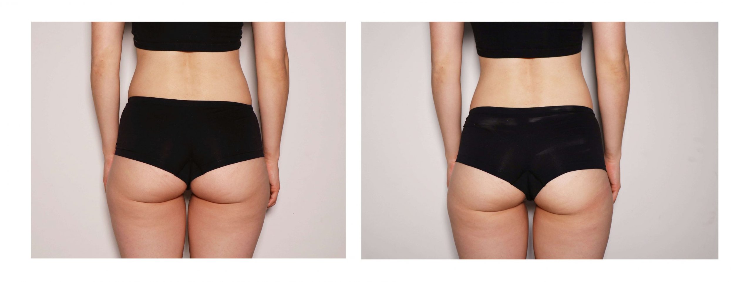 Female-Butt-Toning-Before-After-scaled.jpg