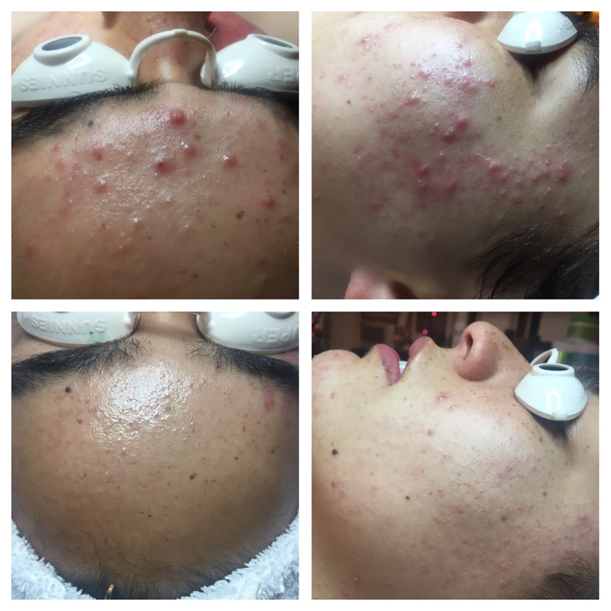 treatments for cystic acne.jpg