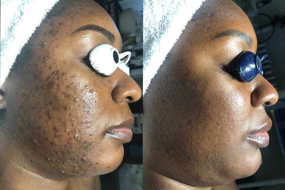 Acne, Scarring and roughness