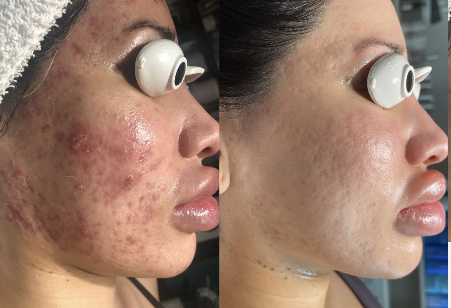 ACNE, INFLAMMATION, SCARRING