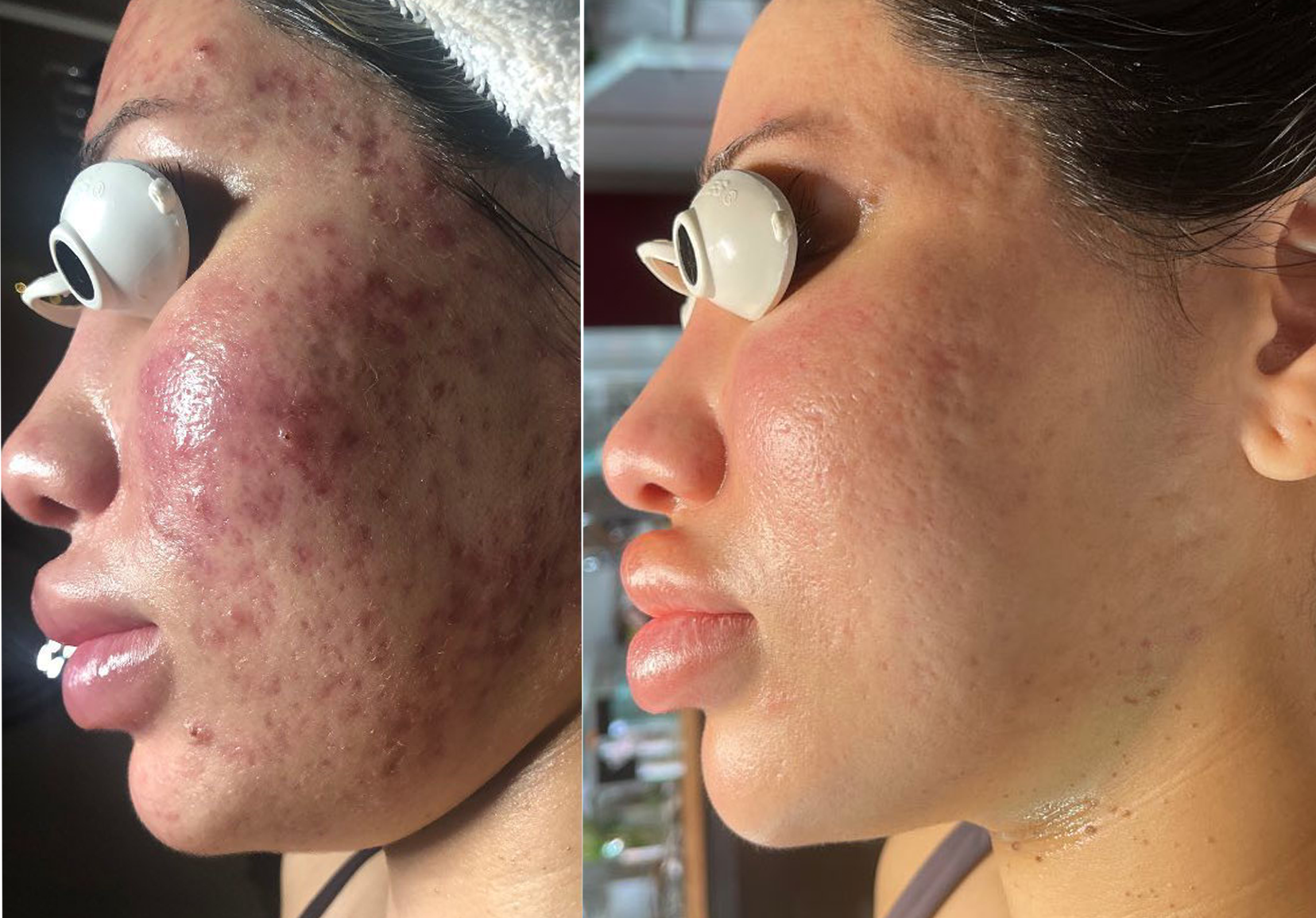 CYSTIC AND INFLAMED ACNE