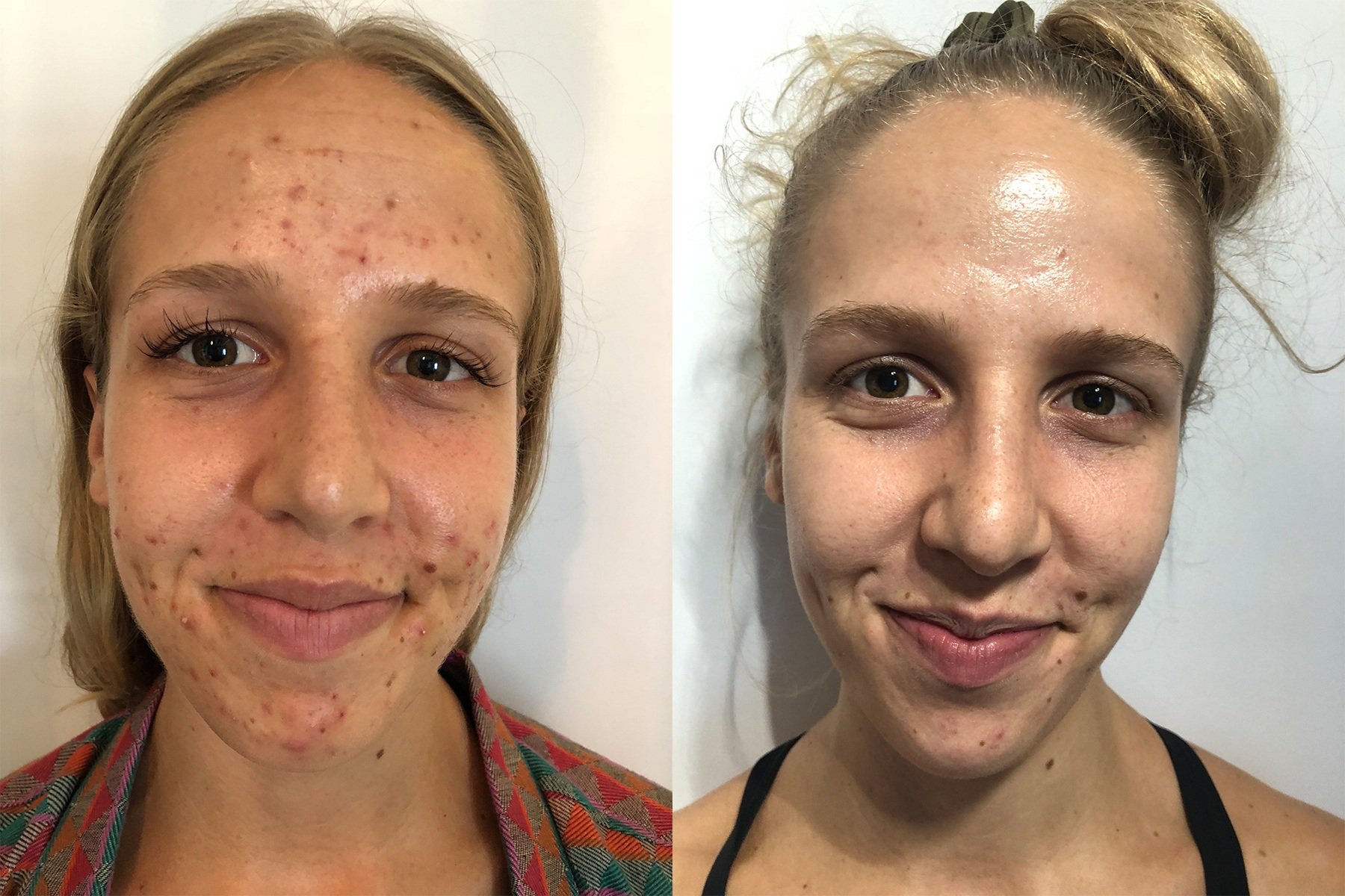 ACNE INFLAMMATION AND SCARRING