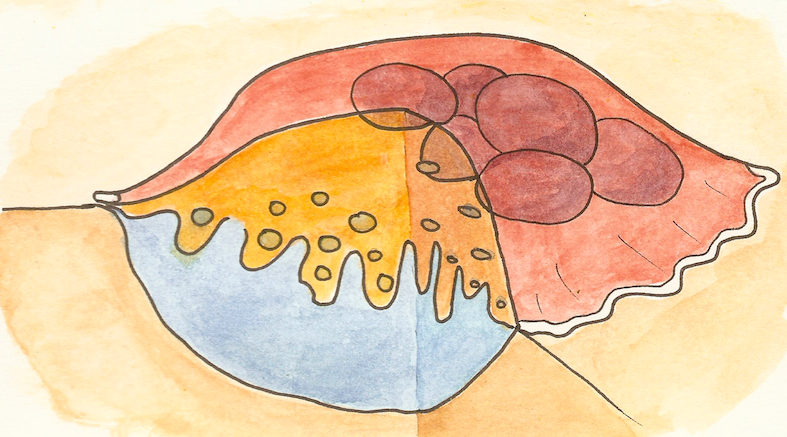 osteoclast pit 2.png