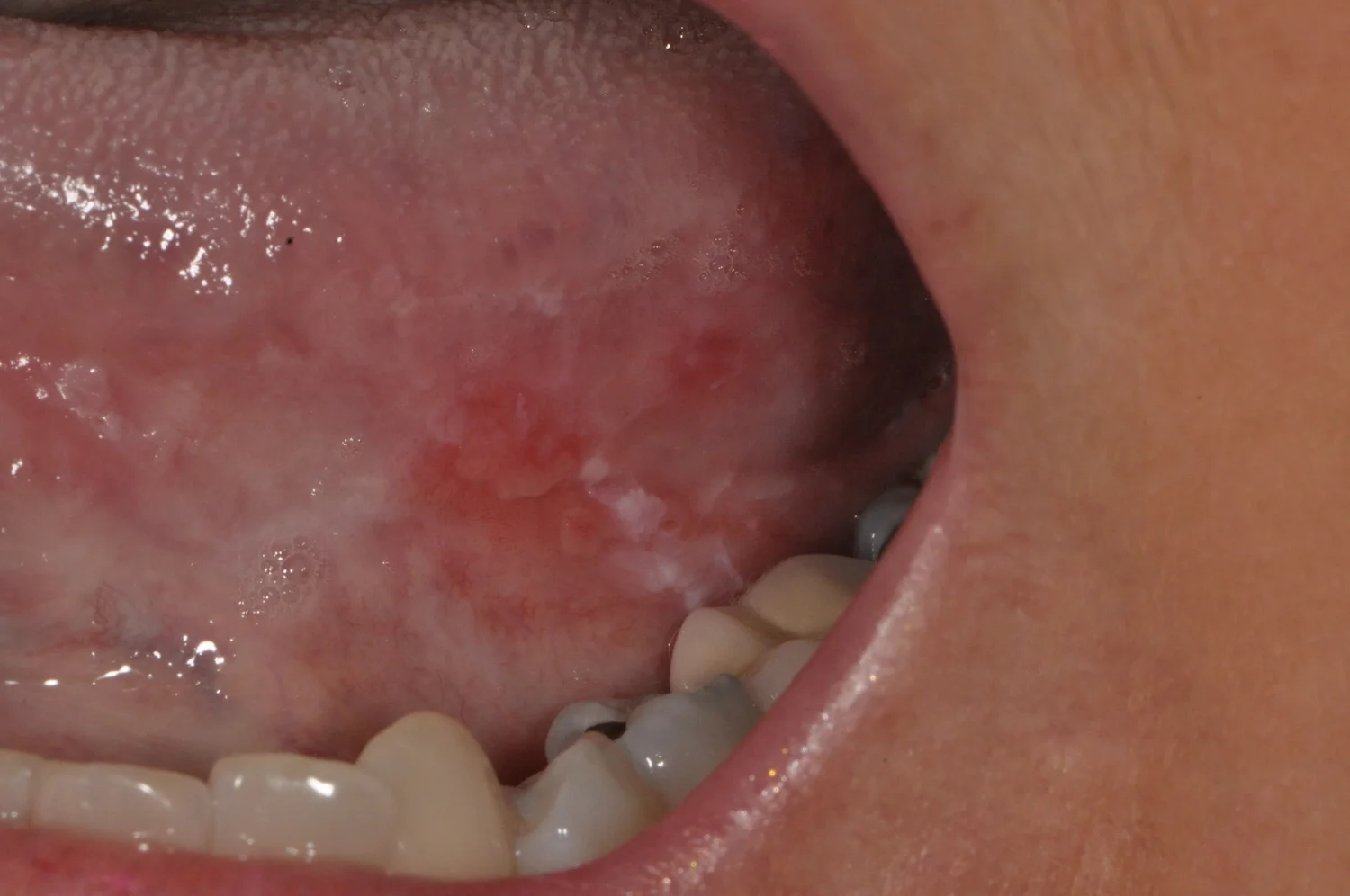 Clinical photograph of a premalignant lesion on the side of the tongue in a nonsmoker, from Dr. CJ Henley's archive