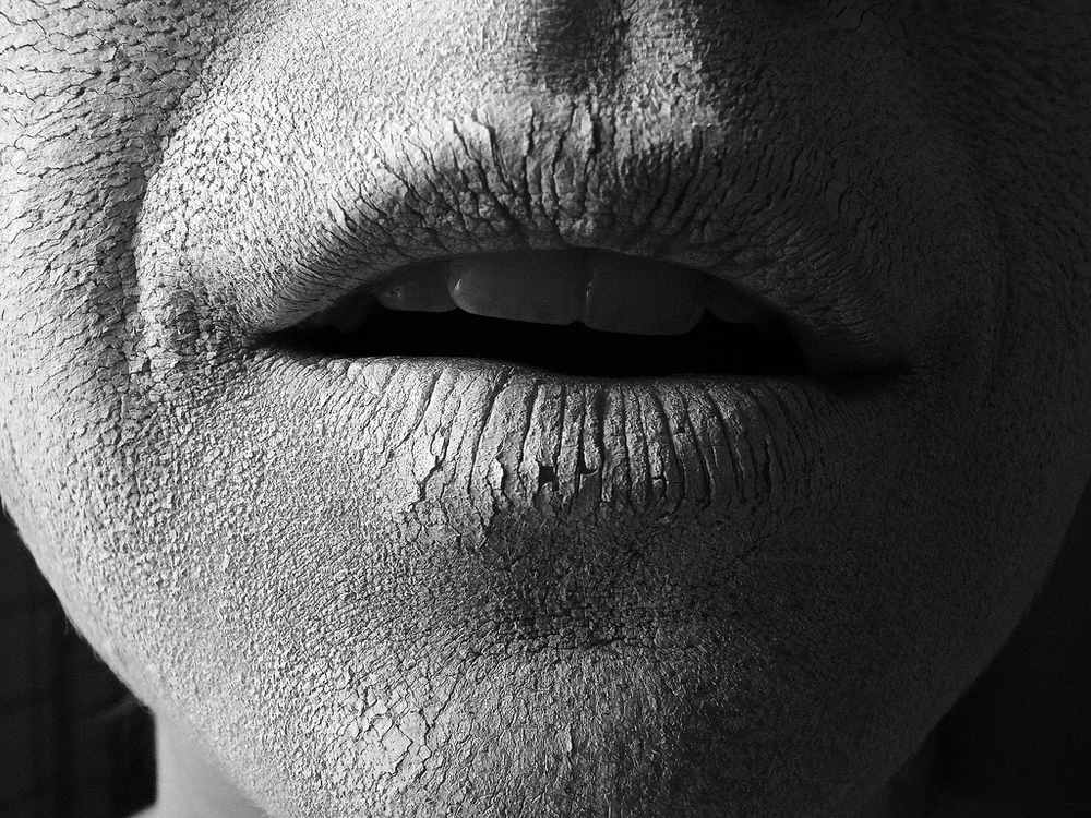 Black-and-white close-up of dry, cracked lips, a common sign of dry mouth (xerostomia)