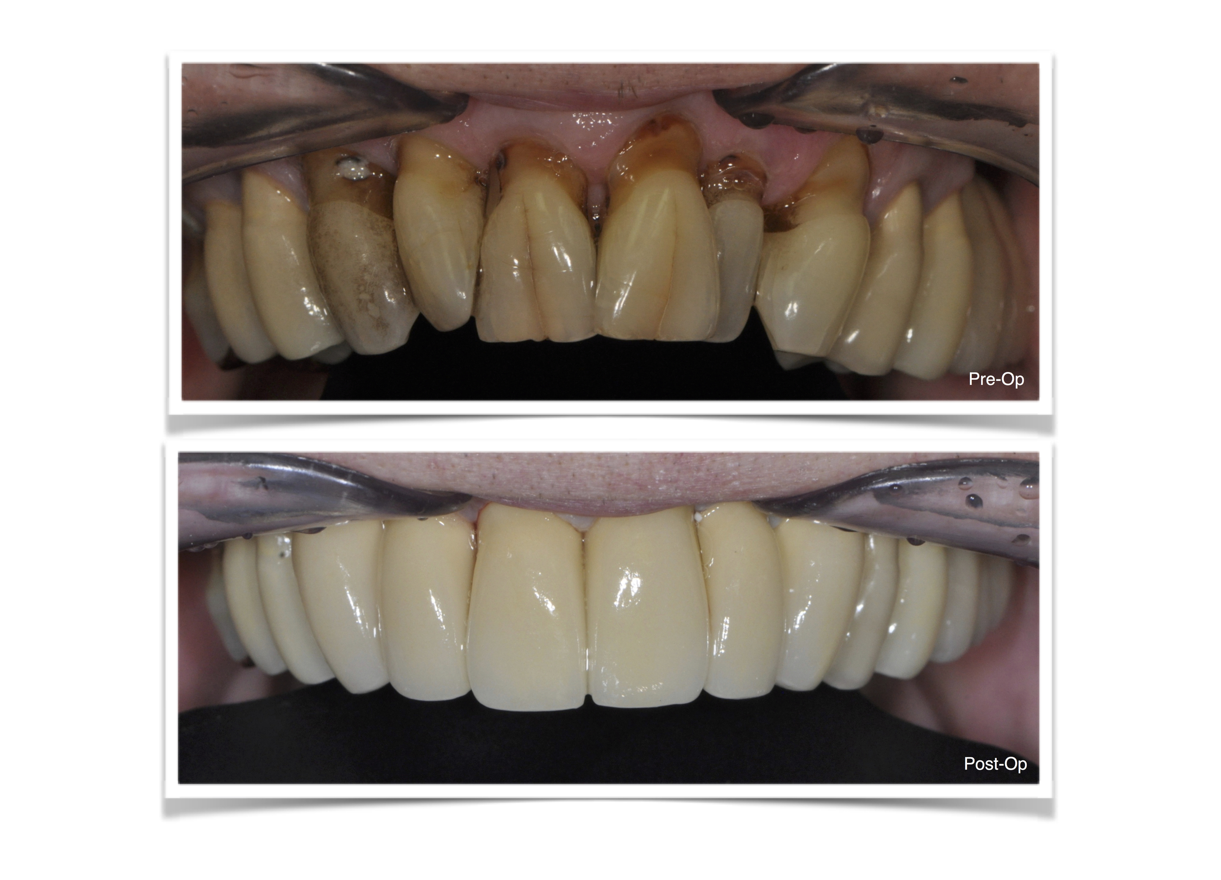 Anterior PFM restorations 