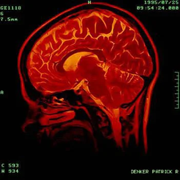 Gum Disease May Worsen Cognitive Decline For Alzheimer's Patients