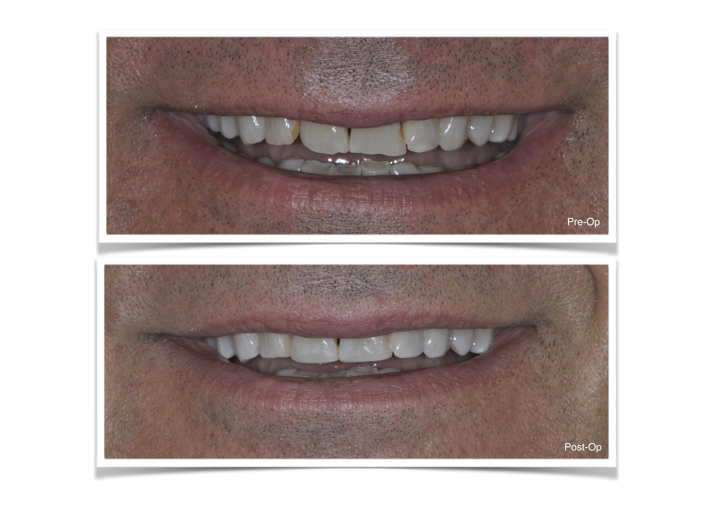 Bonding of Anterior Teeth