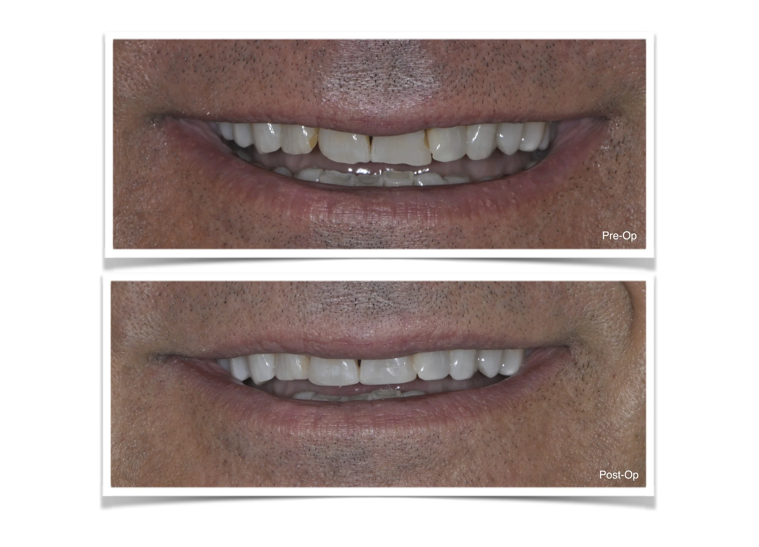 Bonding of Anterior Teeth