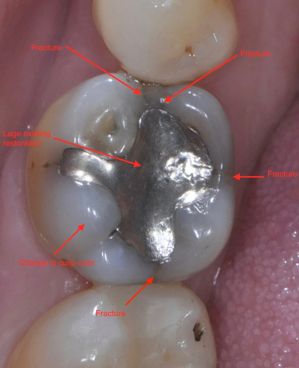 Tooth with a large existing filling before crown treatment, photographed by Dr. C.J. Henley