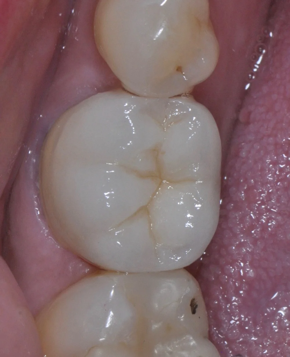 Completed tooth-colored crown shown in Dr. C.J. Henley’s crown treatment guide