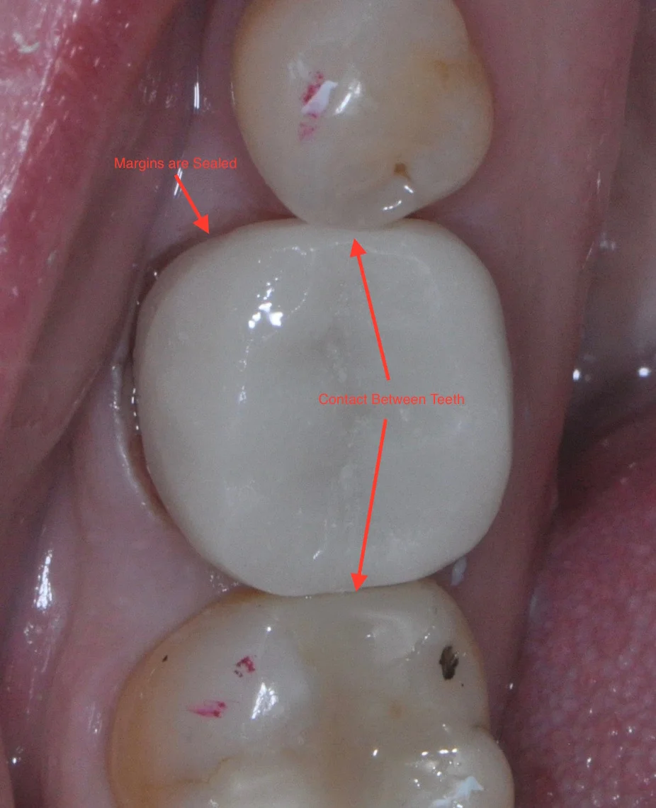 Simply Better DentistryWhy do I need a crown?