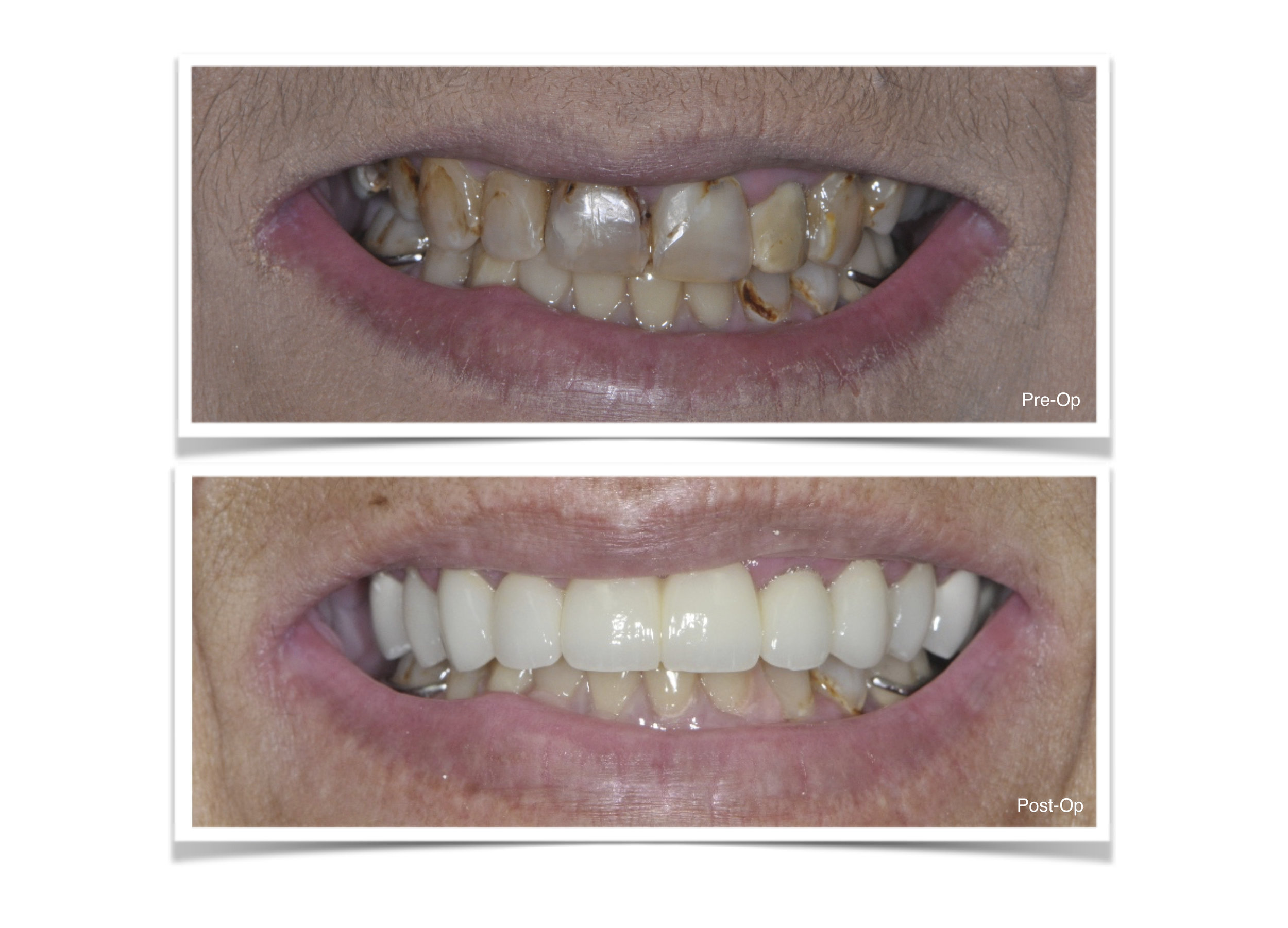 Complete Restoration of the Top Teeth