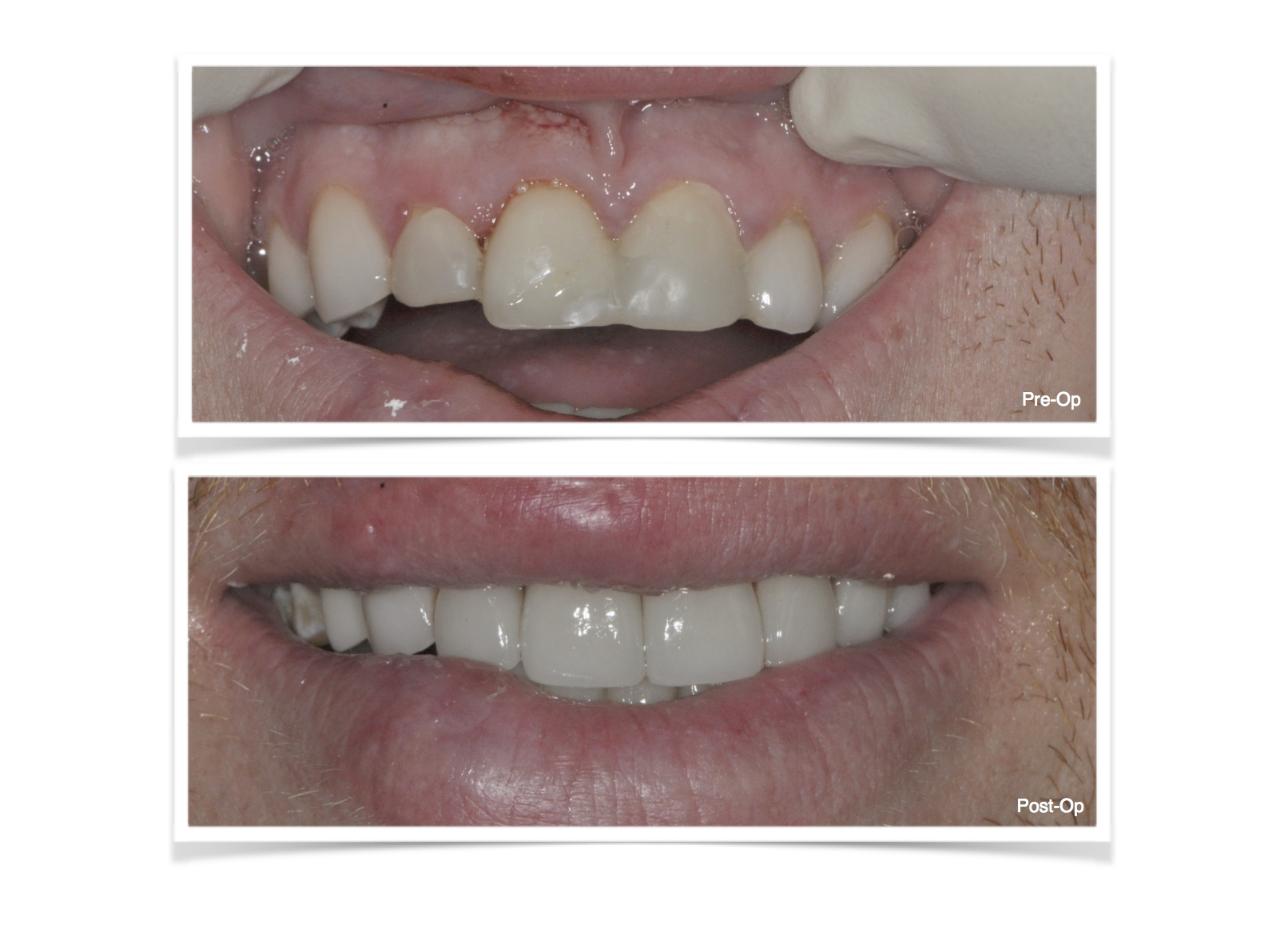 All Ceramic Crowns