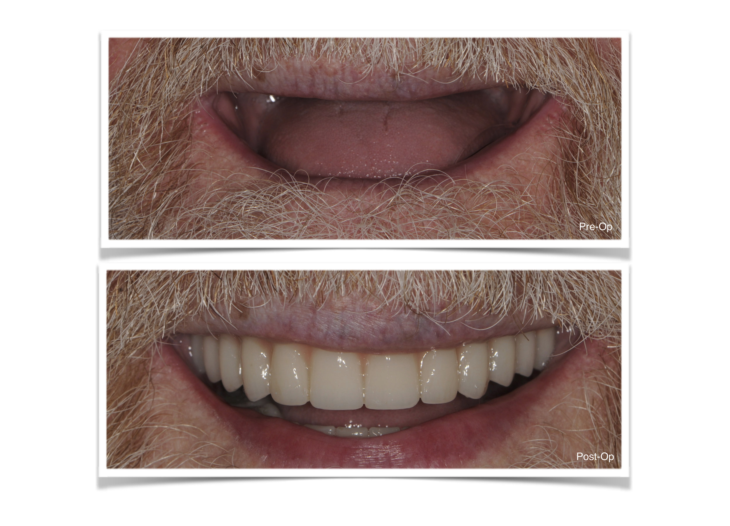 Full Mouth Reconstruction with Hybrid Prosthesis