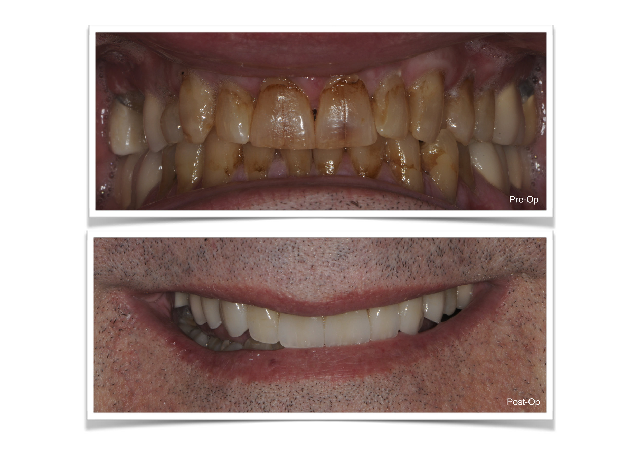 Ceramic Crowns on Front Teeth 