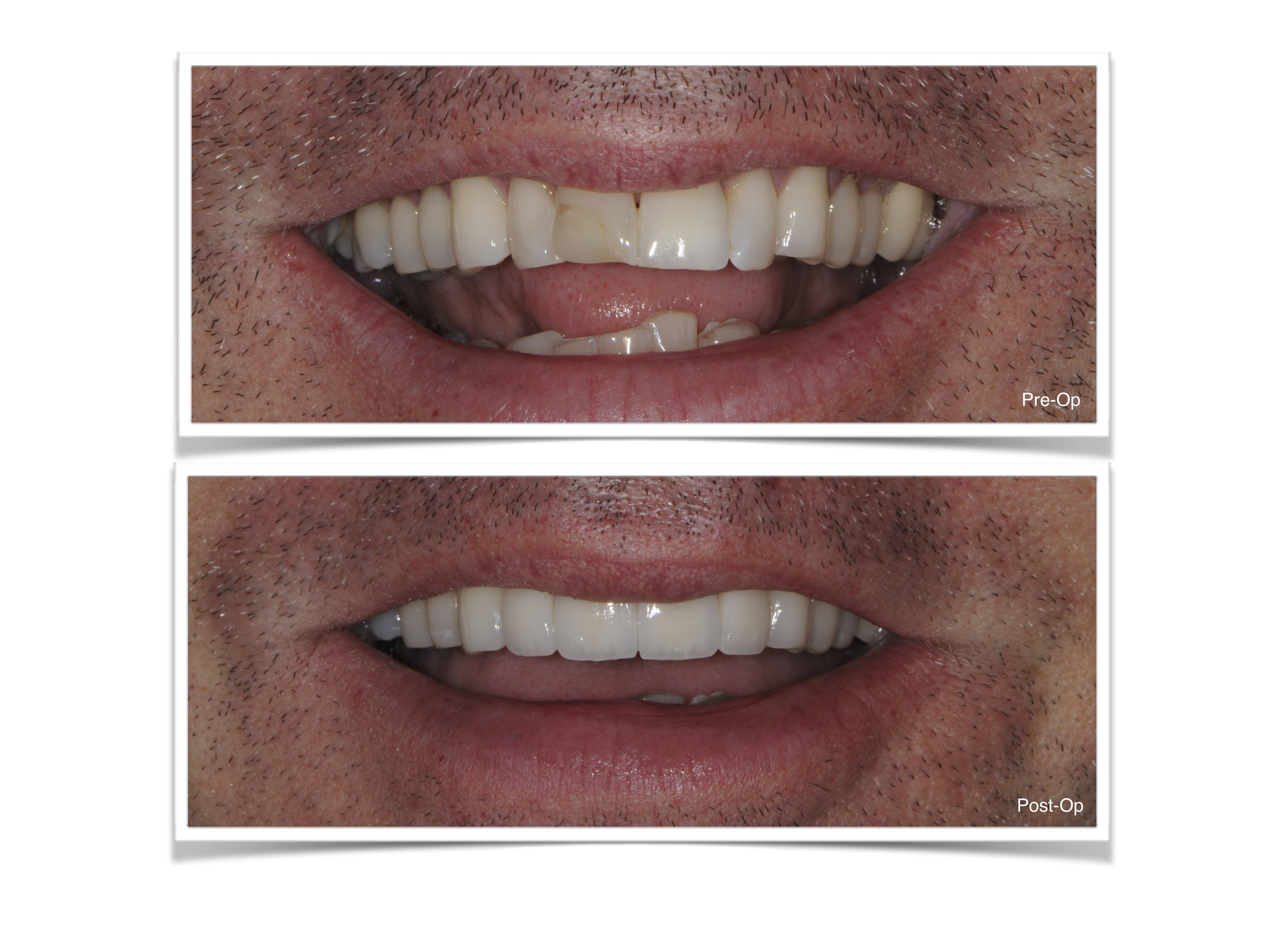 Anterior Crowns (Emax)