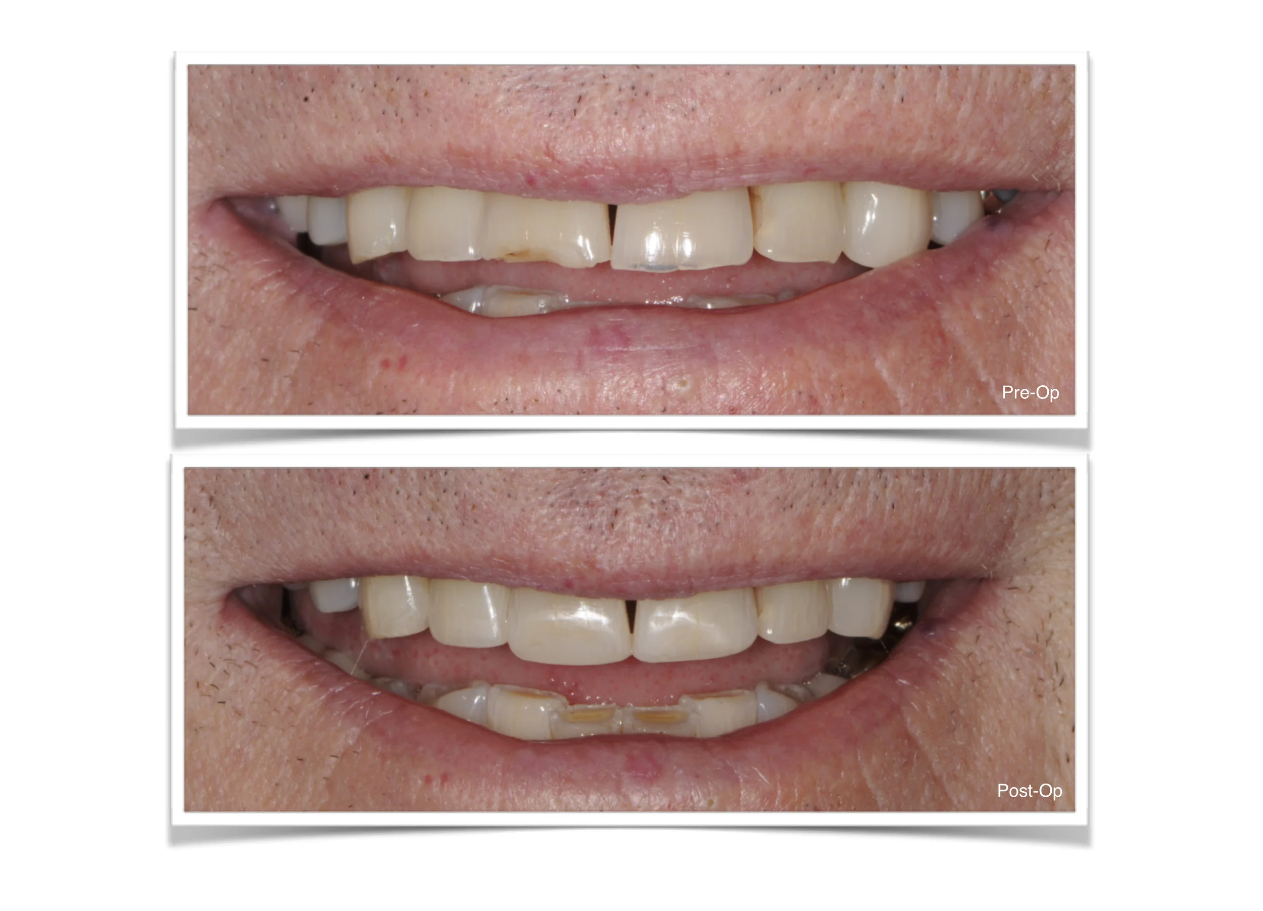 Anterior Bonding