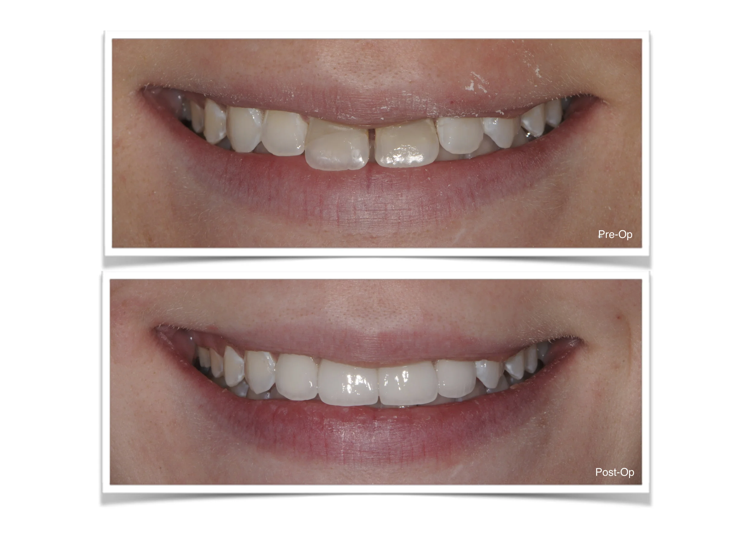 Natural-Looking Front Teeth Crowns: An e.max Smile Case
