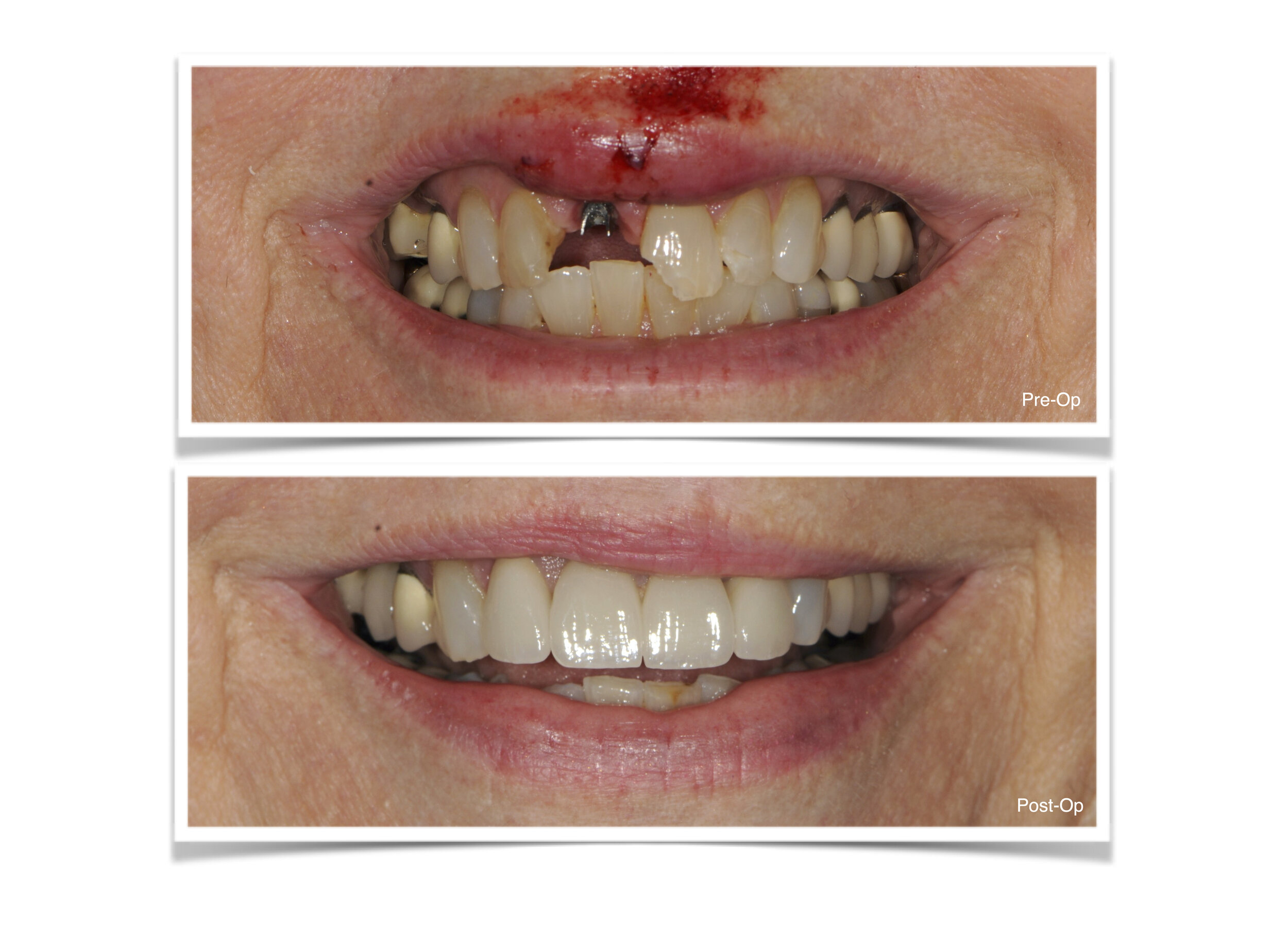 Dental Trauma - Implant Crowns and Traditional Crowns
