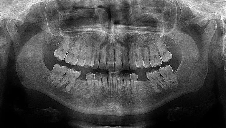 First adult molars are 'living fossils' that hold a 'health record' dating back to the womb
