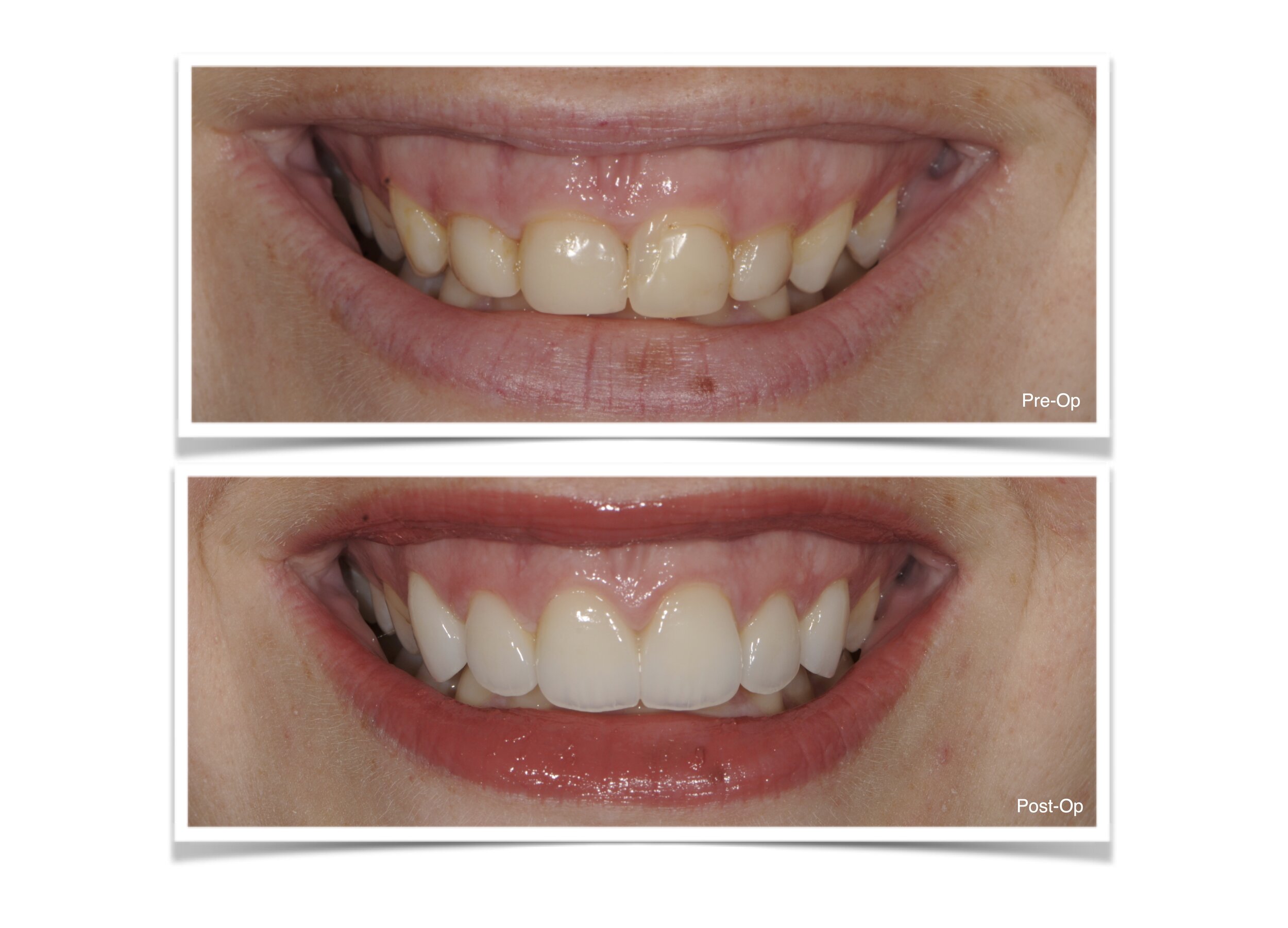 Crown Lengthening and Emax crowns on 6-11