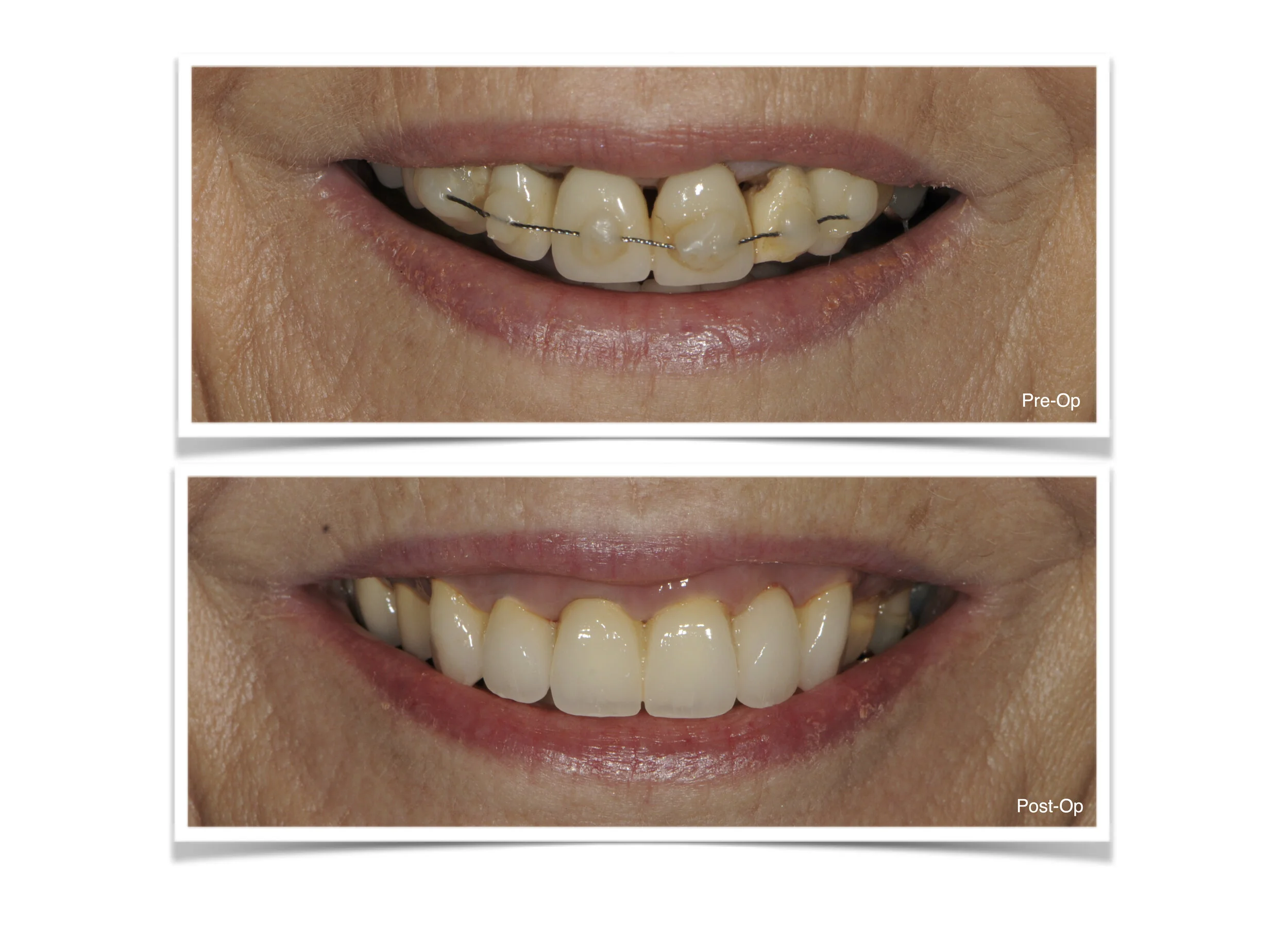 Comparison of teeth before and after dental surgery, with the 'Pre-Op' image showing crooked, discolored teeth with braces, and the 'Post-Op' image showing straighter, whiter teeth.