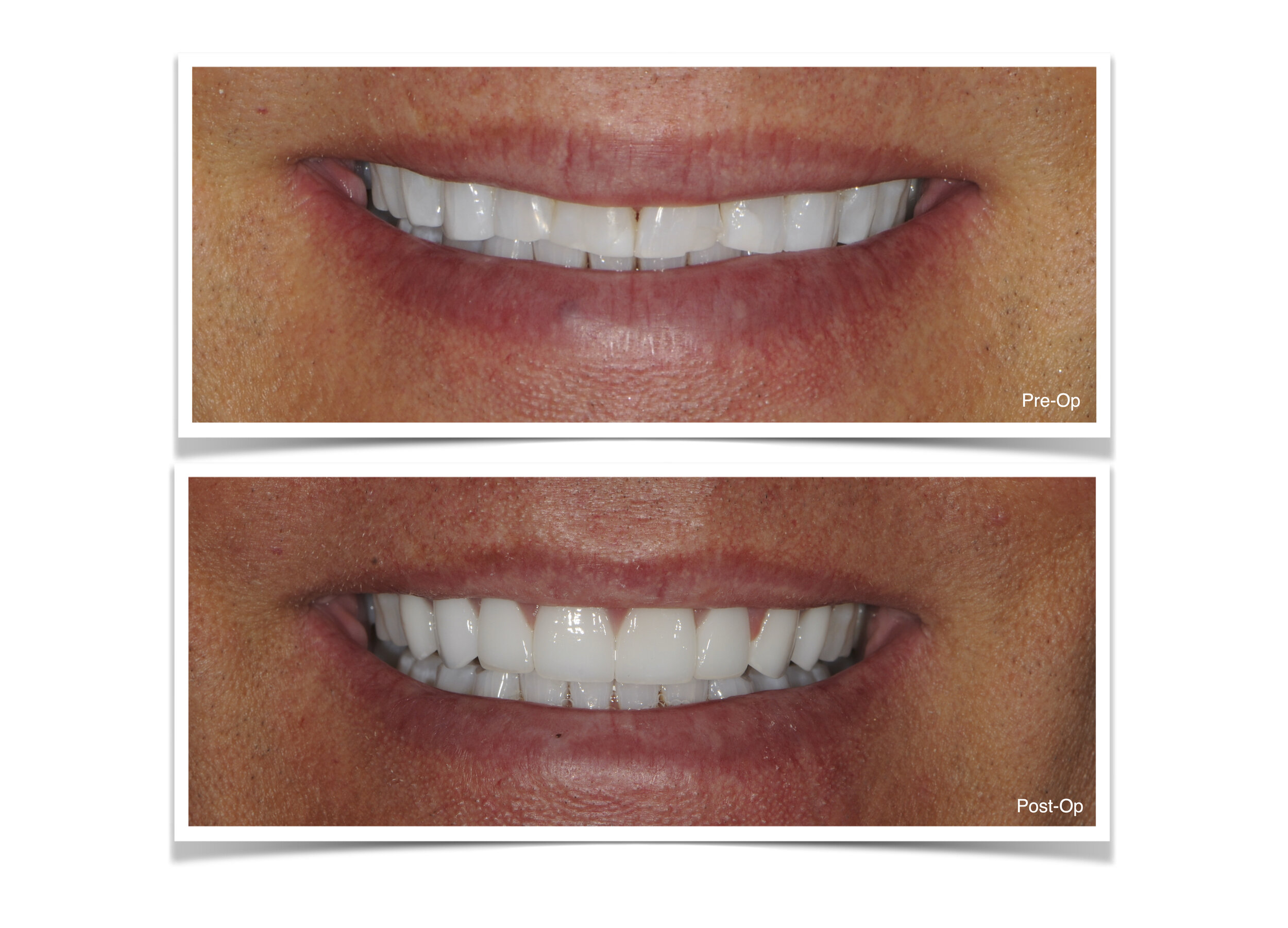 Anterior Veneers Emax - Bleach Shade