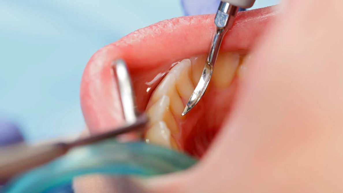 Study offers new insights into dental caries development and prevention