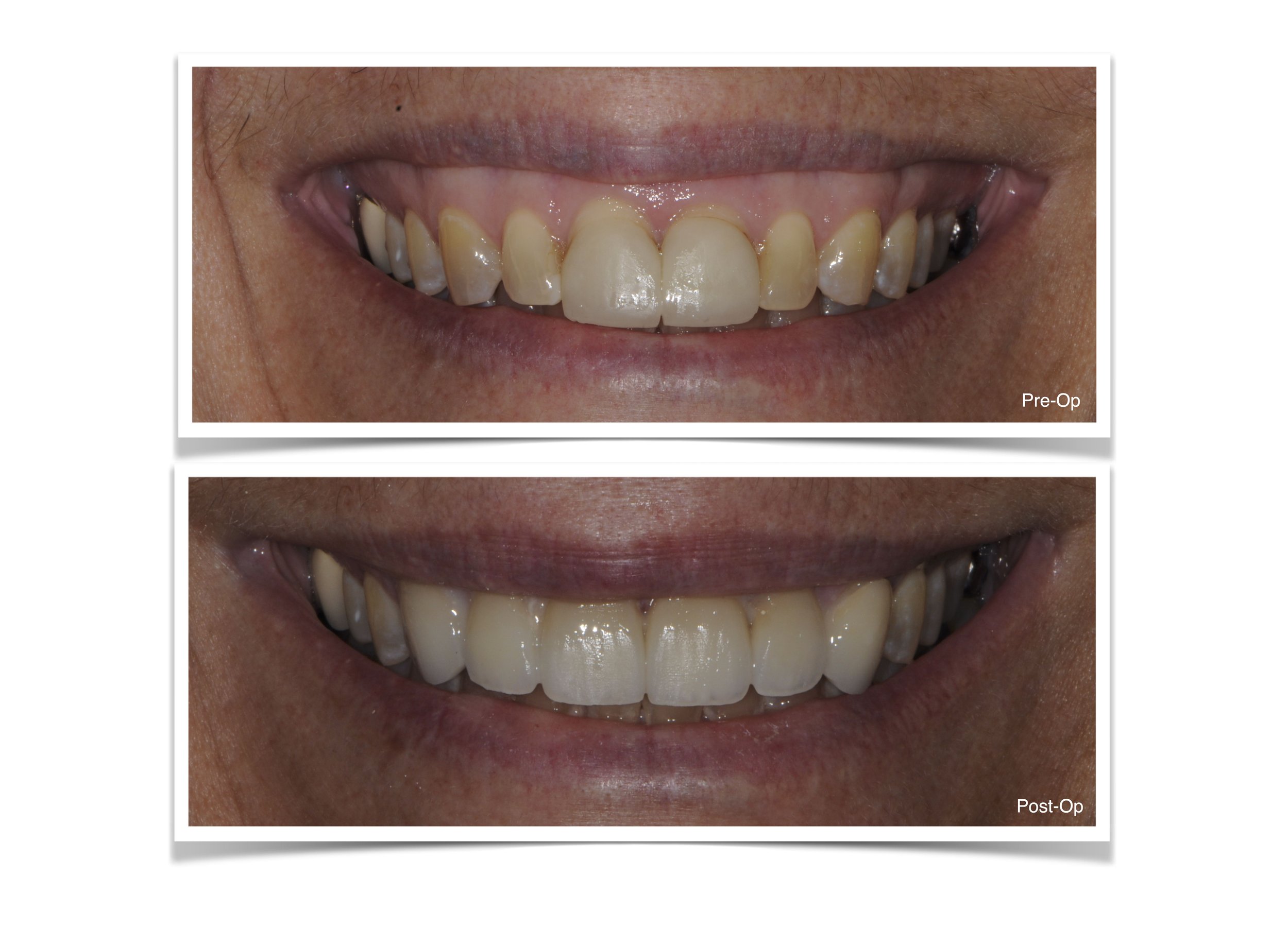 Emax Crowns after orthognathic  surgery