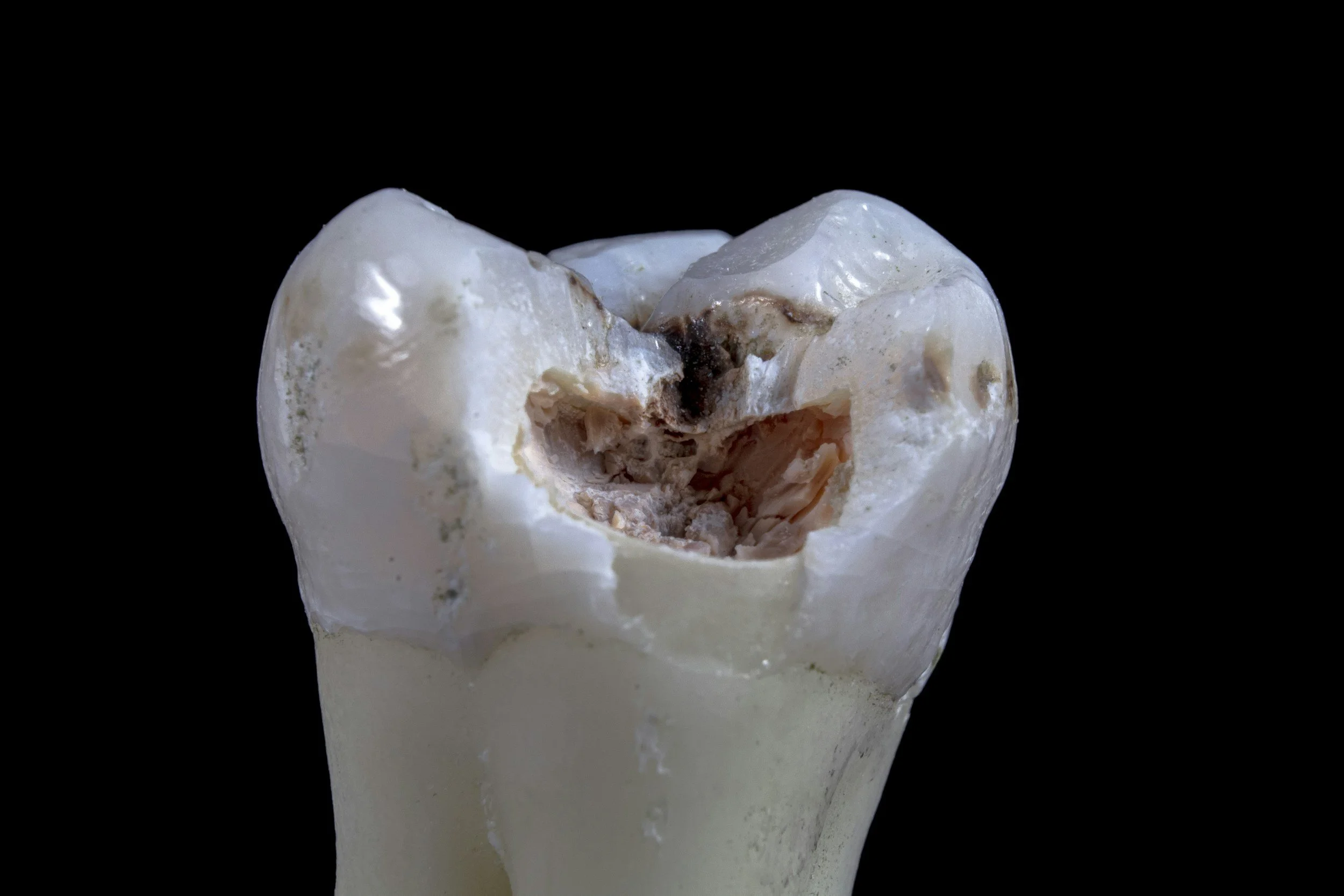 Dental cavity showing tooth decay in enamel and dentin
