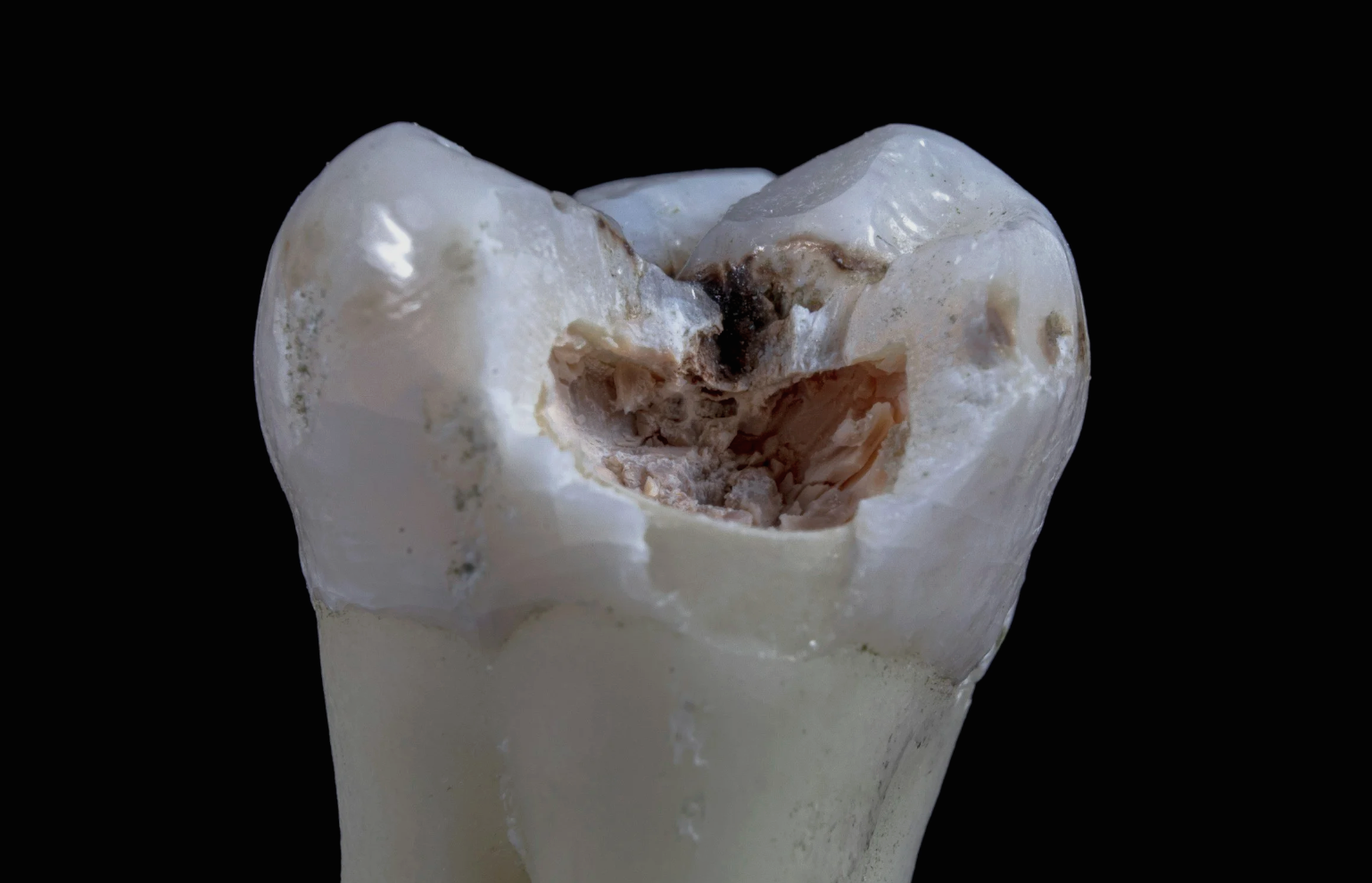 Beyond the Surface: Understanding Dental Caries and Clinical Longevity