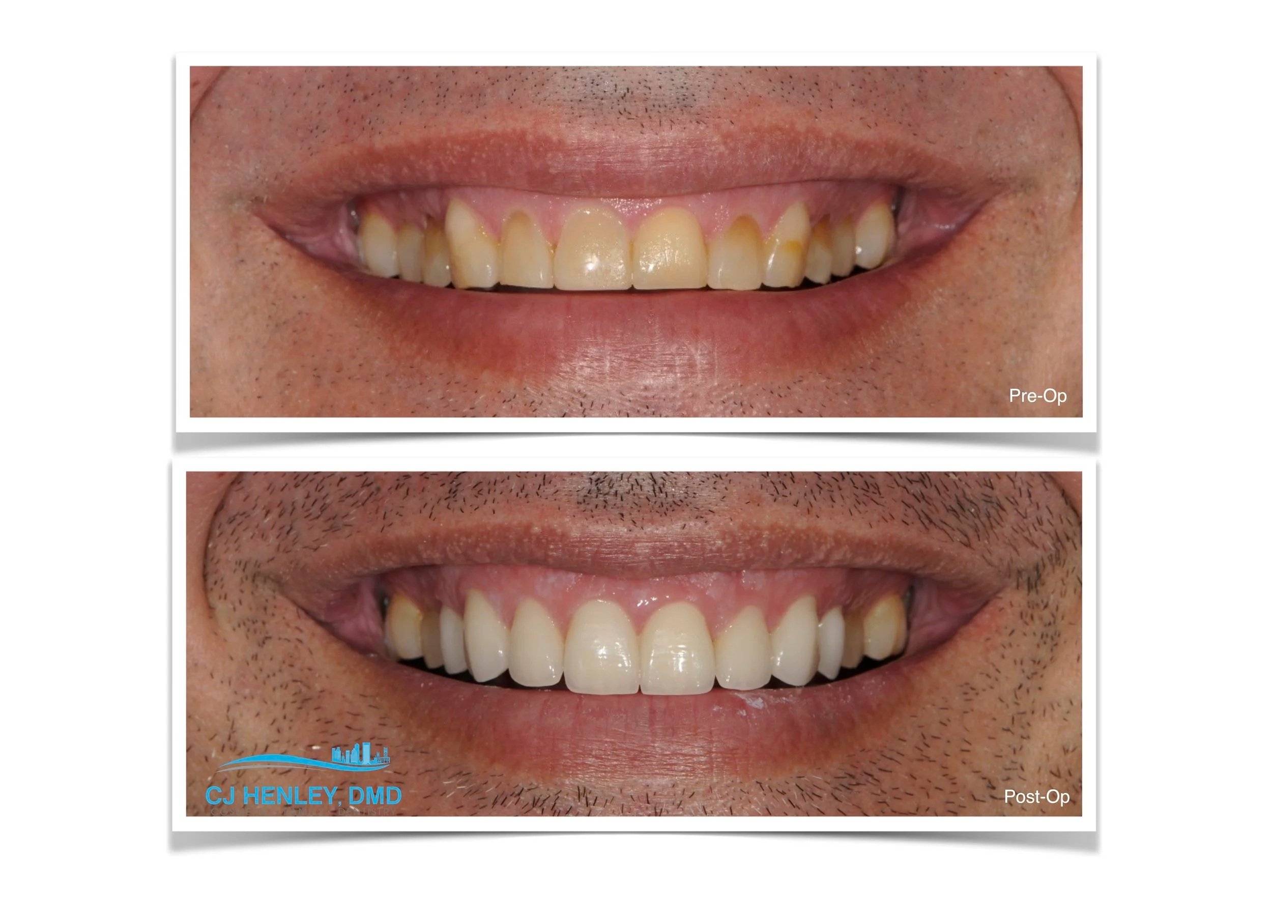 Porcelain fused to zirconia crowns for additional strength.  Combining both beauty and function.    (Copy)