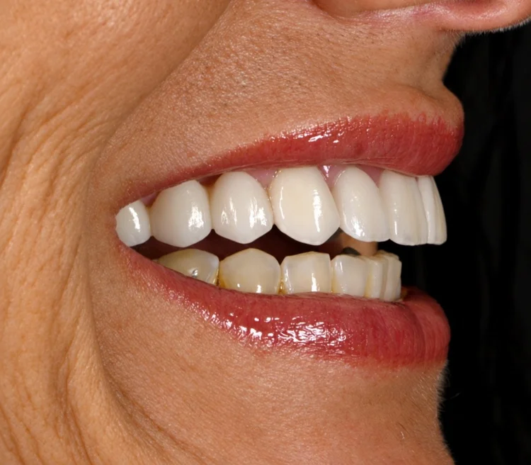 Natural-looking smile from the side after cosmetic dentistry by Dr. CJ Henley in Jacksonville