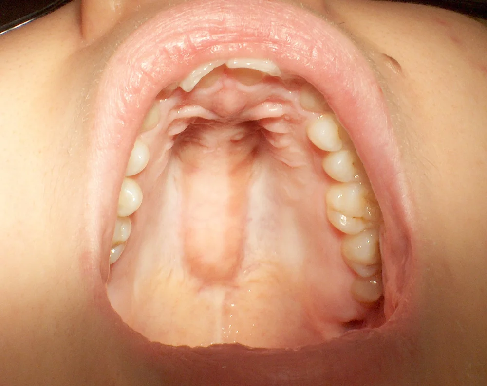 Clinical photograph showing a palatal torus in the middle of the roof of the mouth
