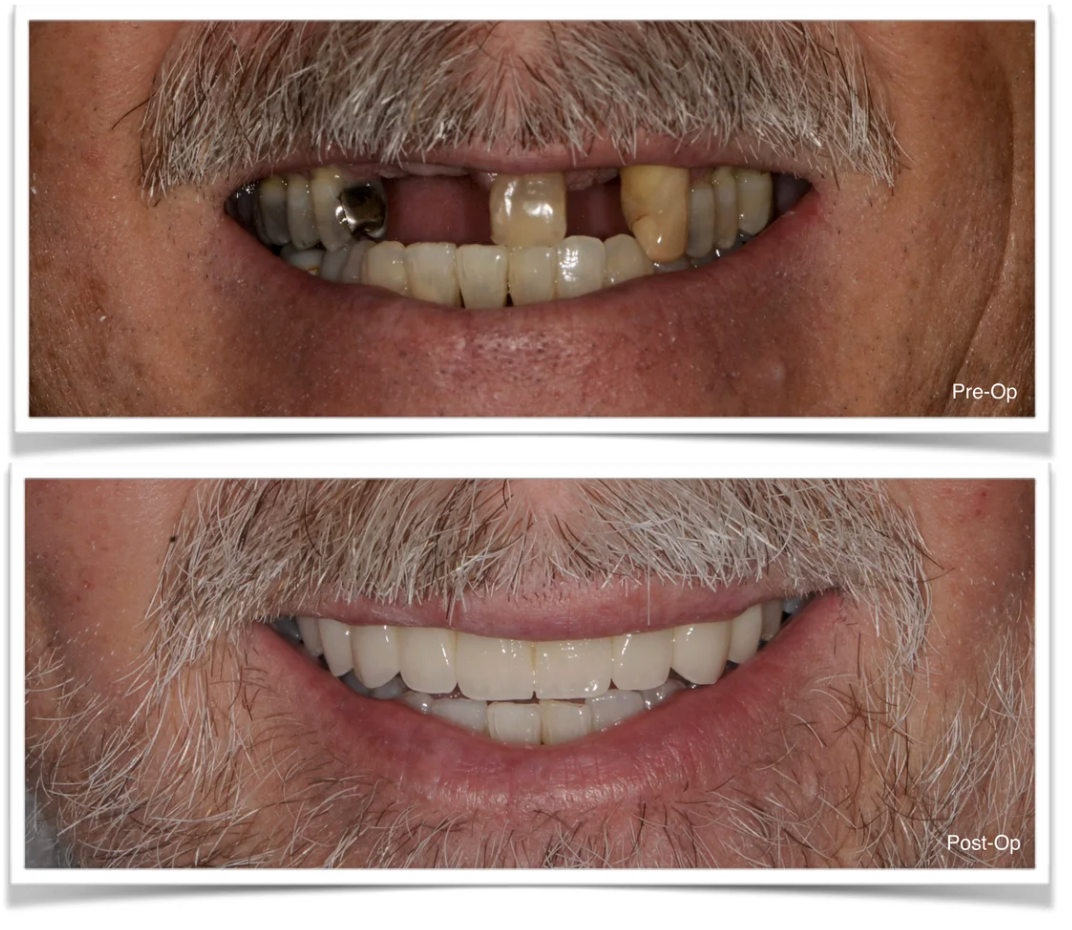 Long-Span Fixed Prosthetic Rehabilitation After Head & Neck Radiation before and after restorative Bridge Jacksonville.