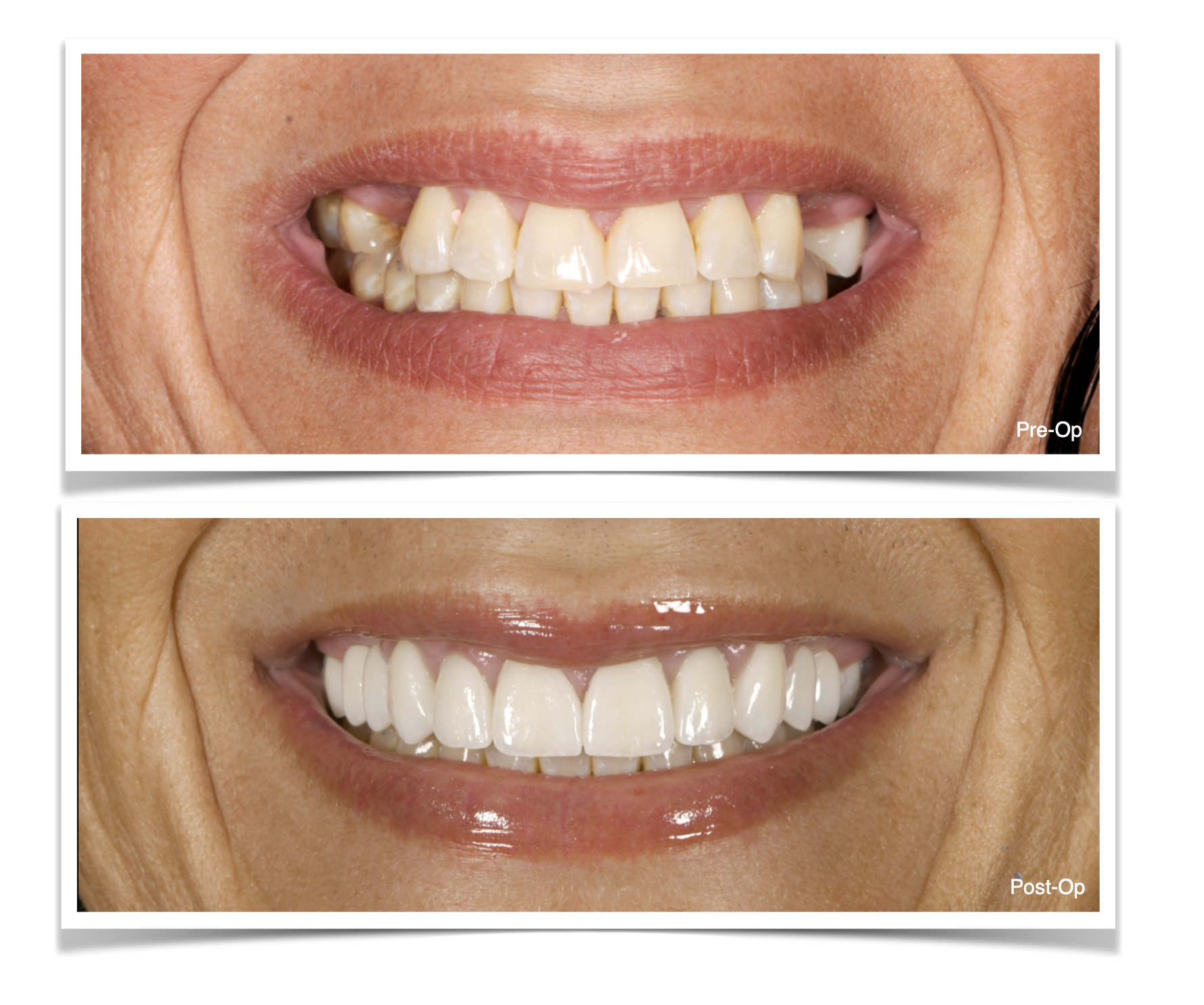This before-and-after case shows a full zirconia smile restoration designed intentionally for strength, function, and long-term durability. In cases with heavy bite forces or higher fracture risk, materials like e.max or layered zirconia may not alwa