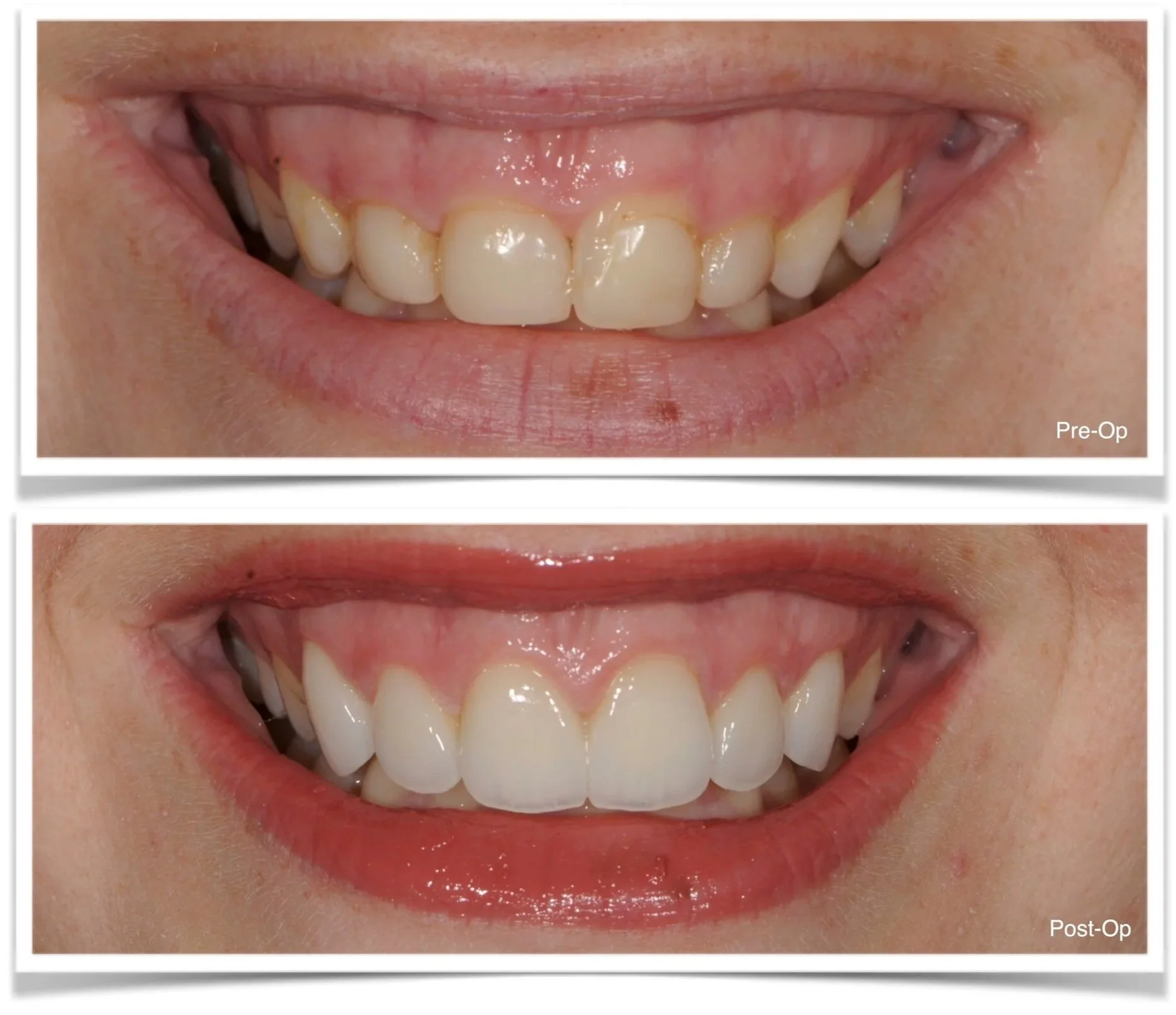 Before and after gummy smile correction with diode laser crown lengthening and layered e.max anterior restorations with incisal edge translucency.