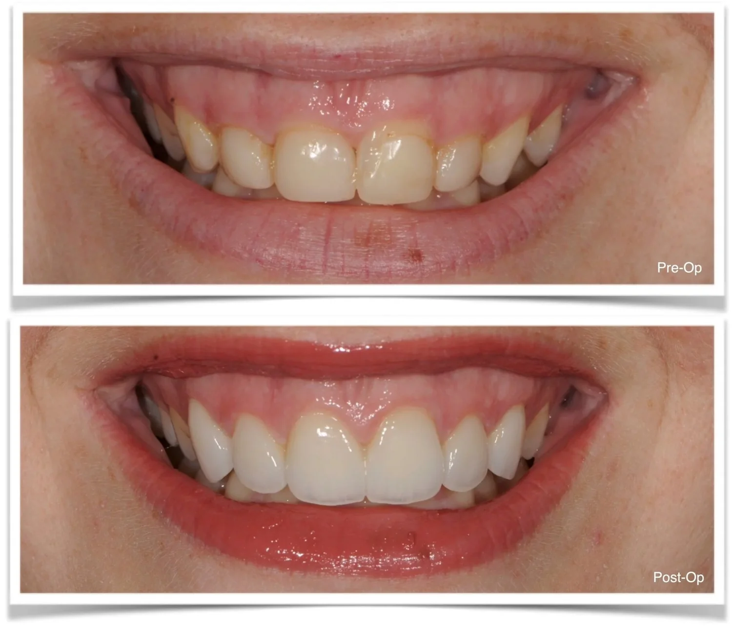 Porcelain veneers before and after — smile makeover by Dr. CJ Henley, Jacksonville FL