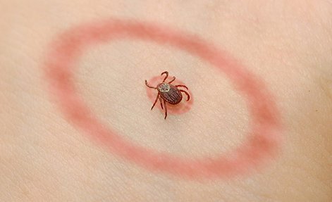 lyme-disease-tick-bite.jpg