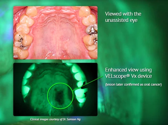 Velscope can help detect oral cancer. 